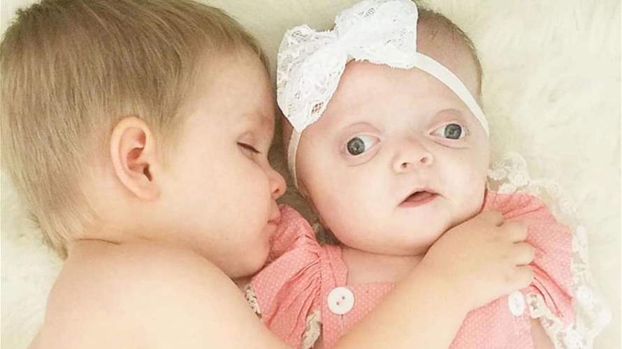 في يومها العالمي... 5 حقائق لا تعرفونها عن اضطرابات الكروموسومات النادرة