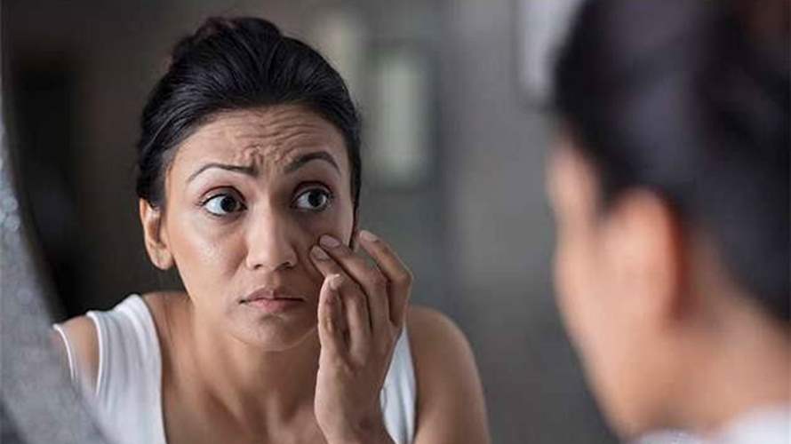 الهالات السوداء تحت العين قد تخفي مشكلة صحية… أطباء يحذرون من نقص الحديد