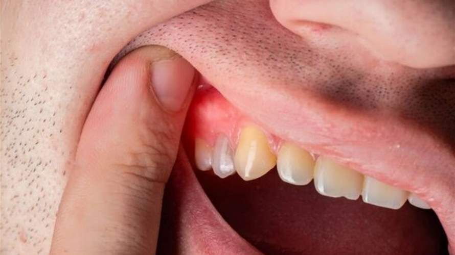 لا تتجاهل ما يحدث في فمك… علامات قد تنذر بأمراض خطيرة: ما هي؟