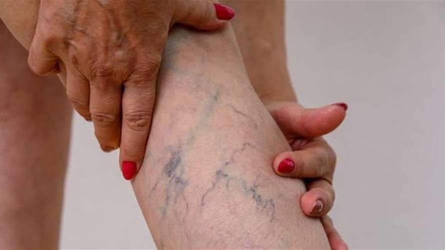 الجلوس والوقوف طويلاً… كيف تعالج دوالي الساقَين قبل تفاقمها؟
