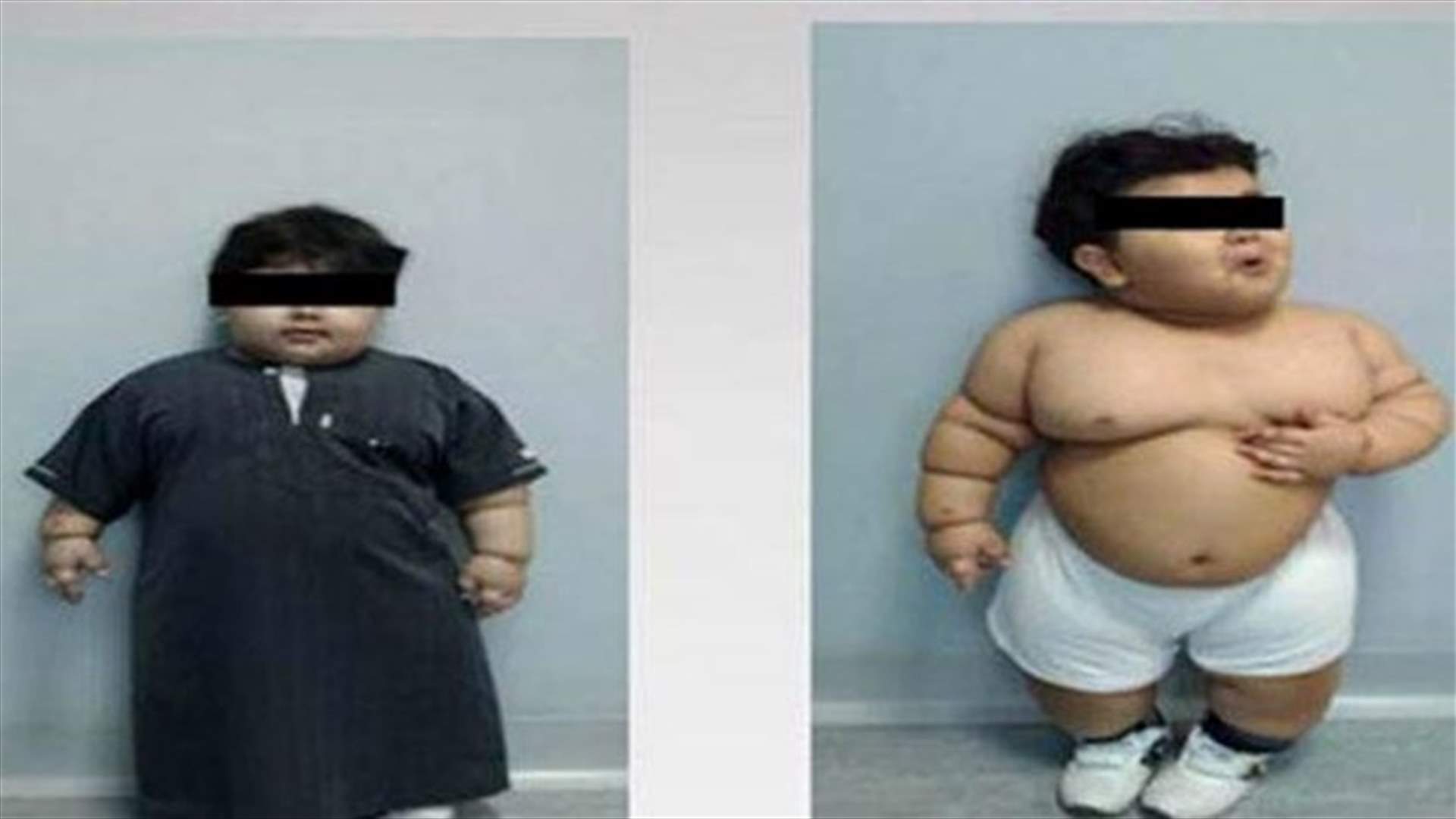 Two-year-old Saudi toddler has gastric bypass surgery