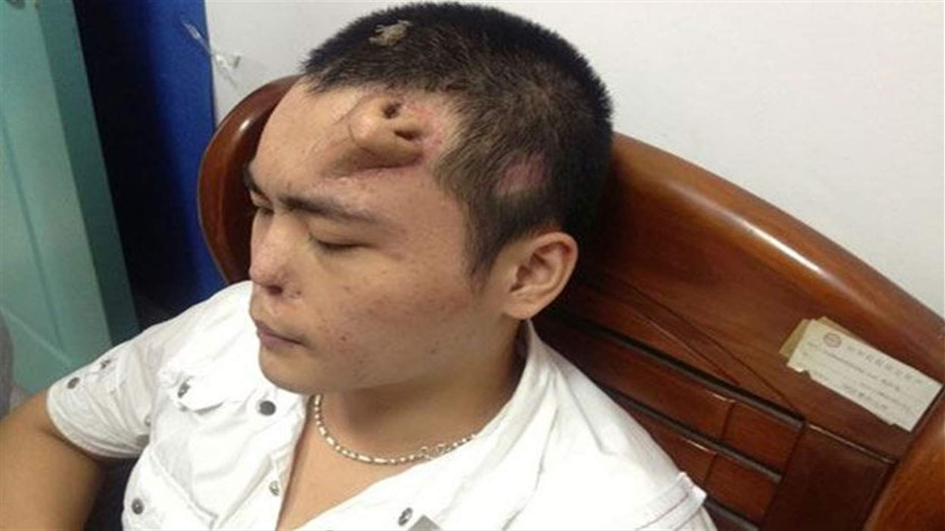 Chinese man has new nose grown on his forehead