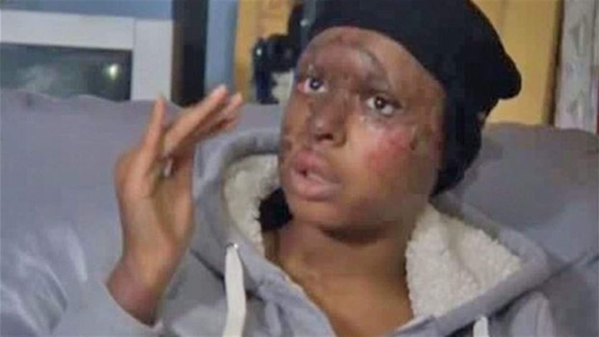بالصور: حرقتها بـ "الأسيد" لكونها أجمل منها