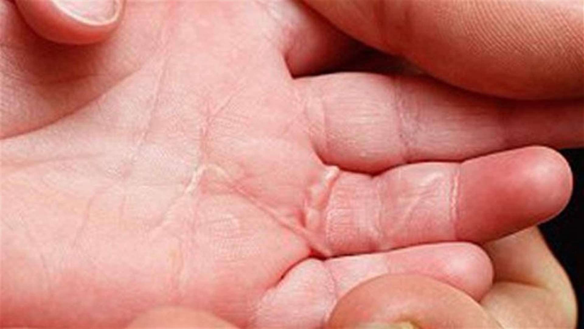 بالصور... طفل يستعيد عافيته بعدما قضم ثعلب اصبعه