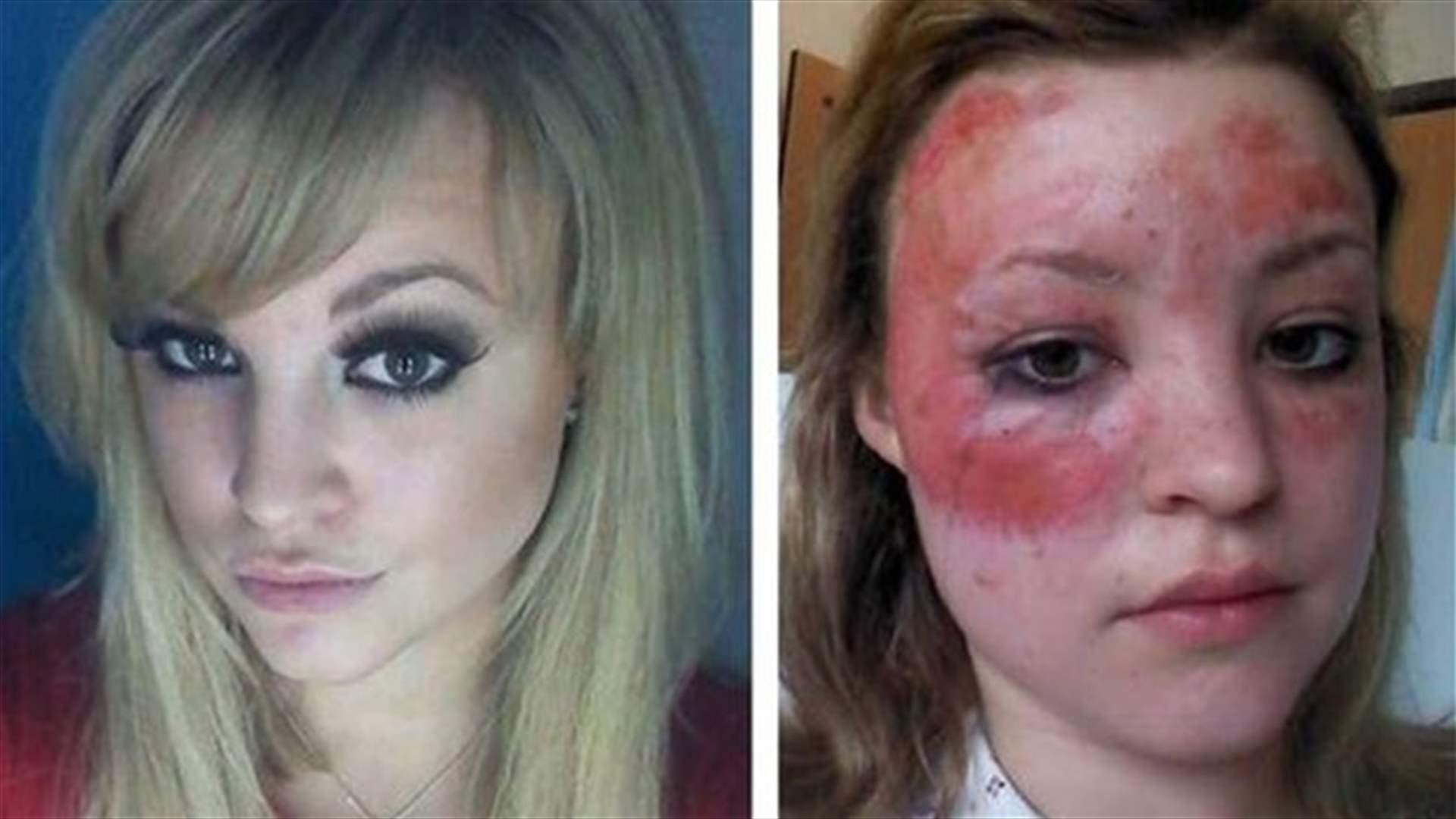 احترقت بعد أسبوع من تأهلها لنهائيات مسابقة ملكة جمال
