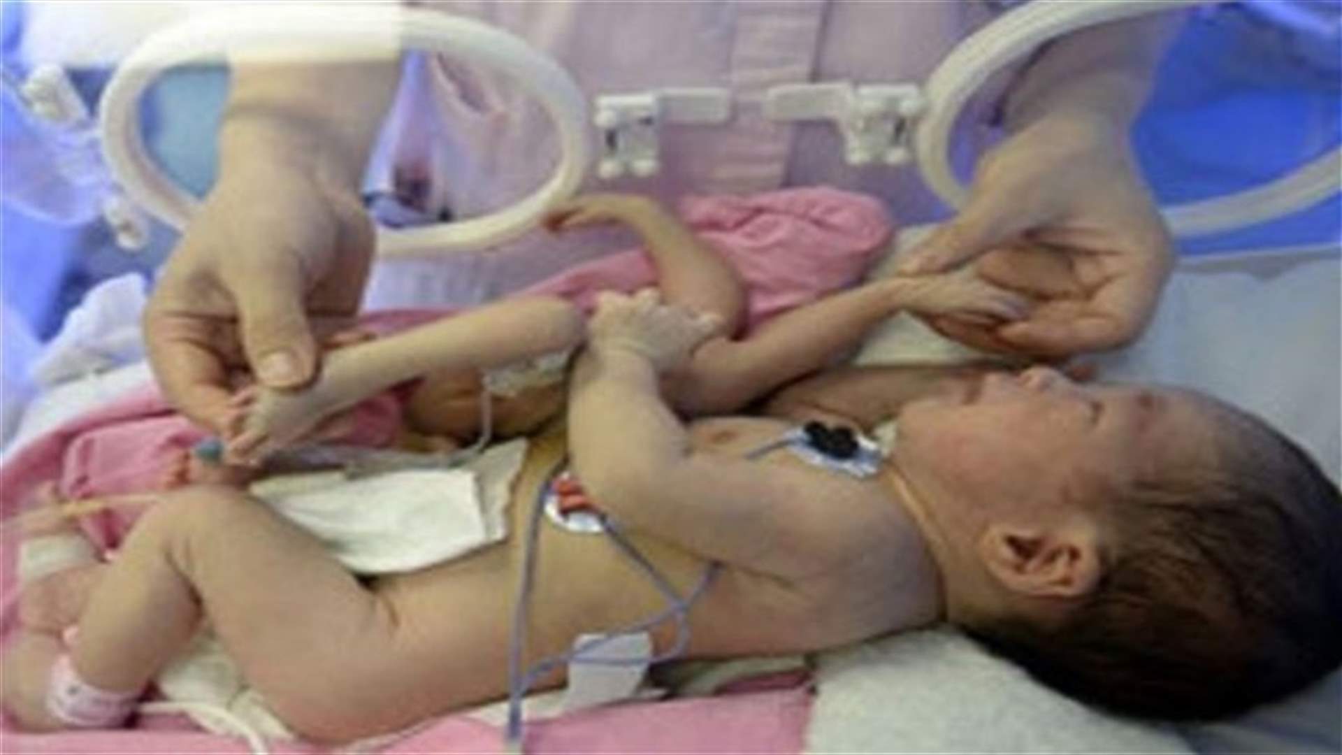 ولادة طفل بـ 8 أطراف ...والسبب