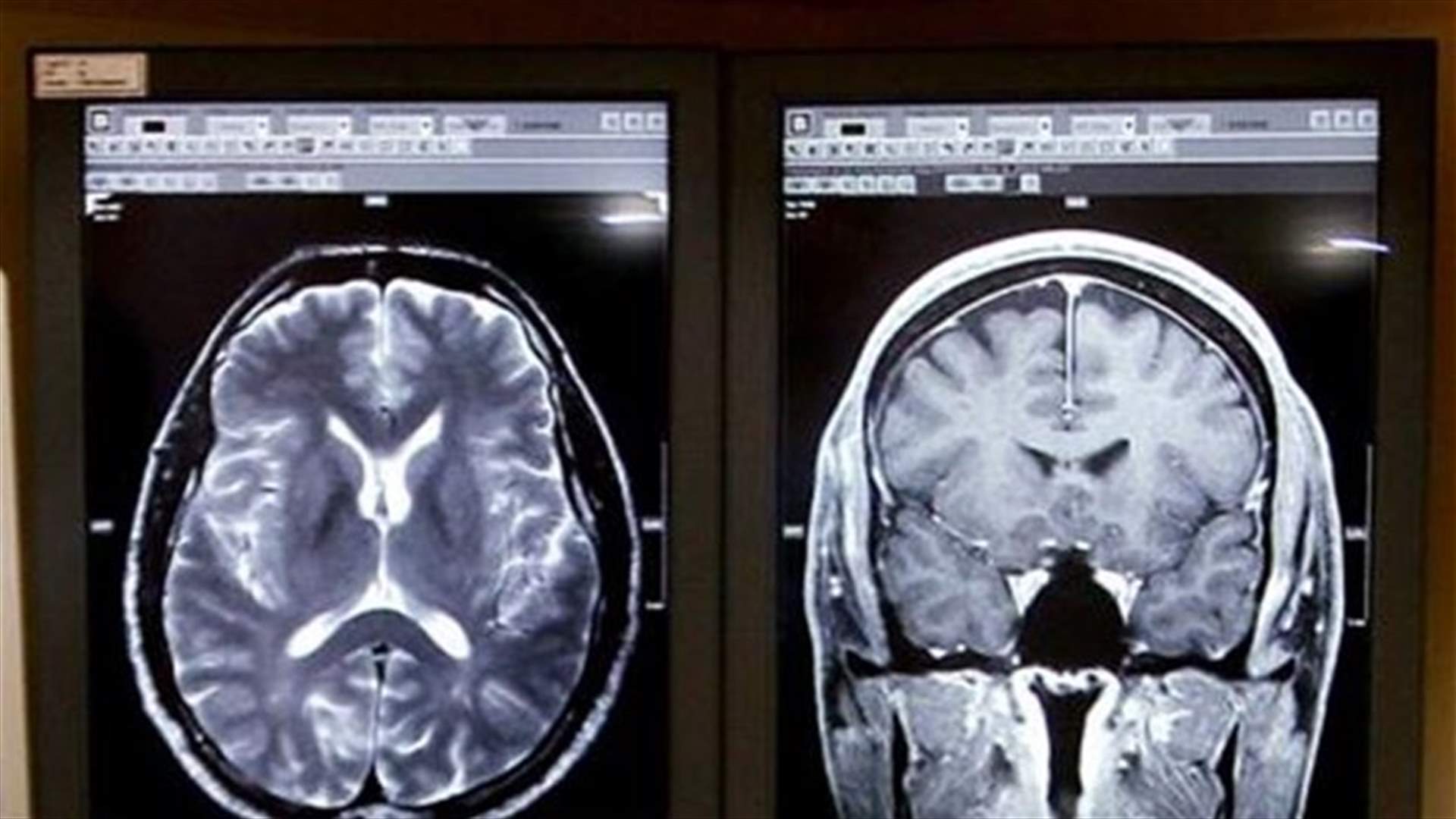 Scientists discover new rare genetic brain disorder 