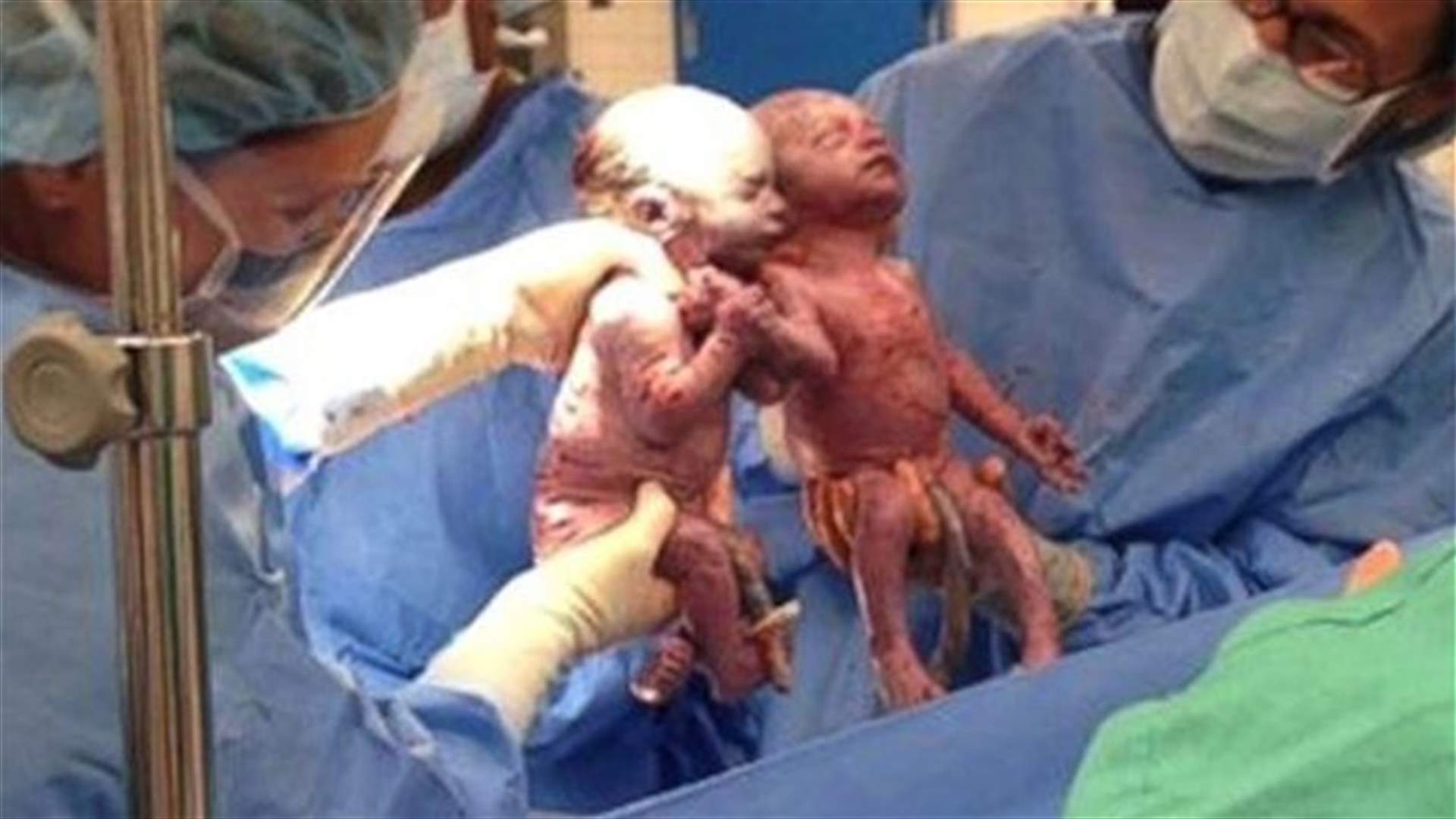 Rare 'mono mono' newborn twins doing well in US