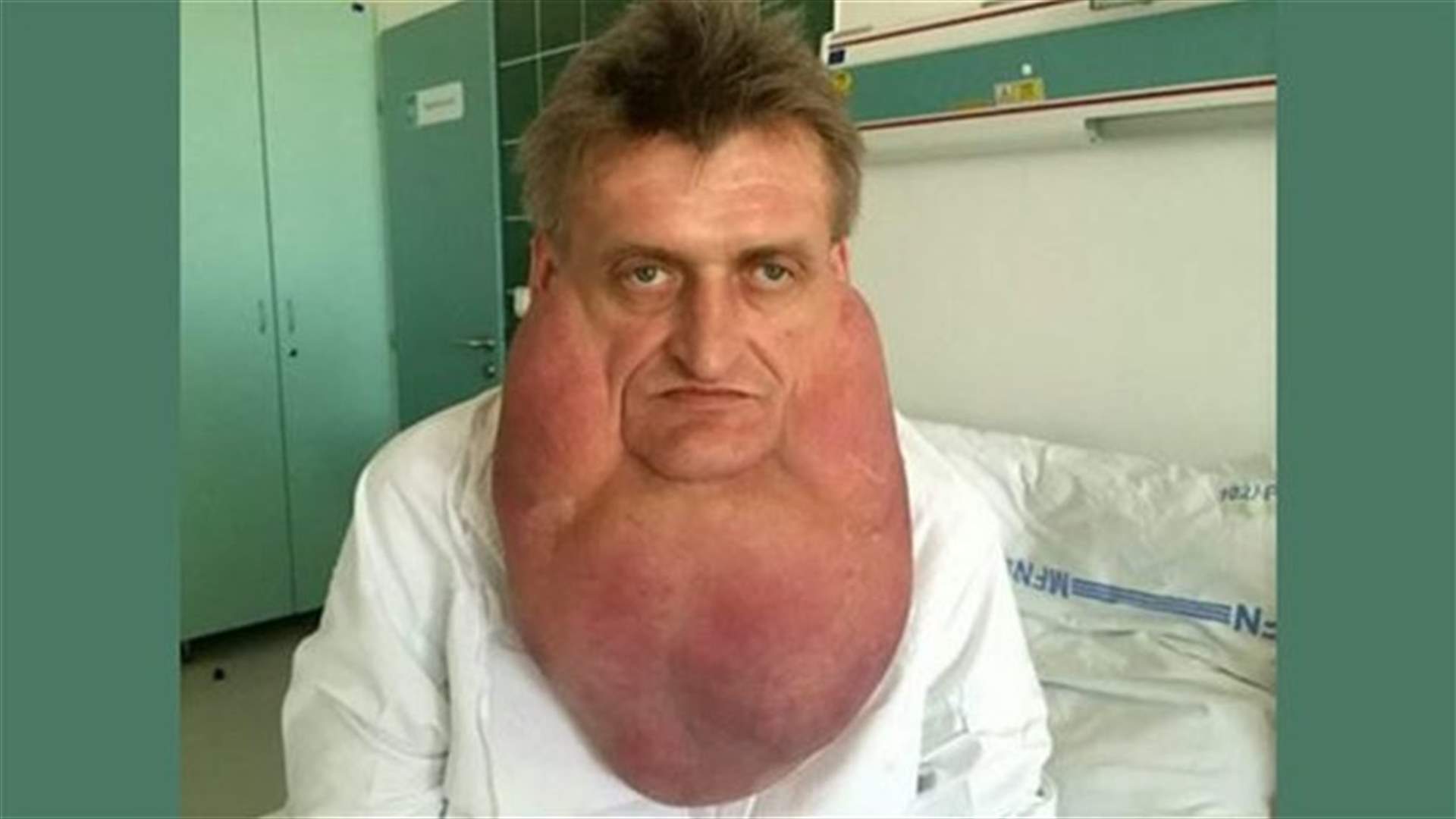 استئصال ورم يزن 6 كلغ من رقبة رجل