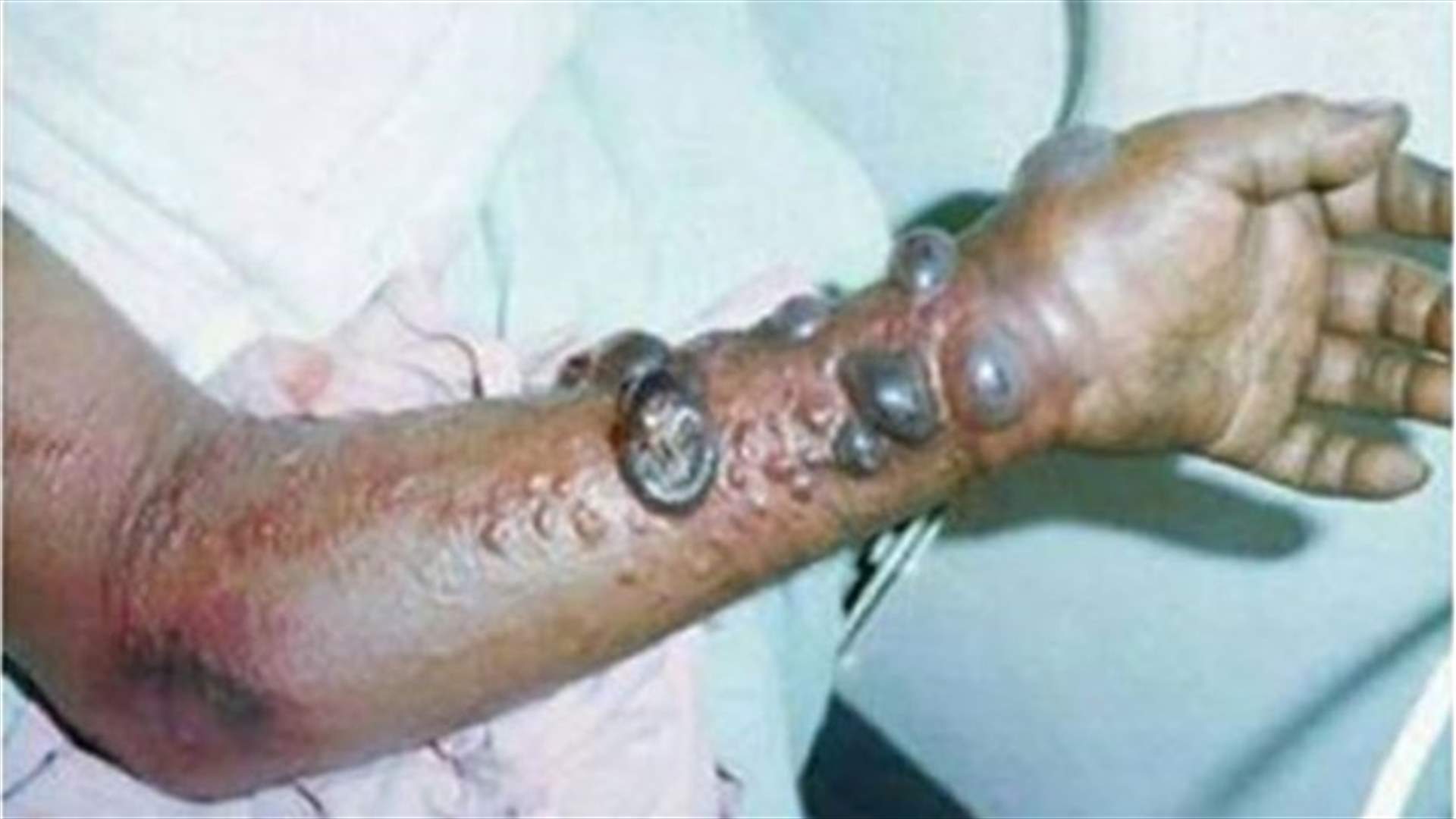 الامم المتحدة تحذر من ان "الحرب" على ايبولا قد تستمر 6 اشهر