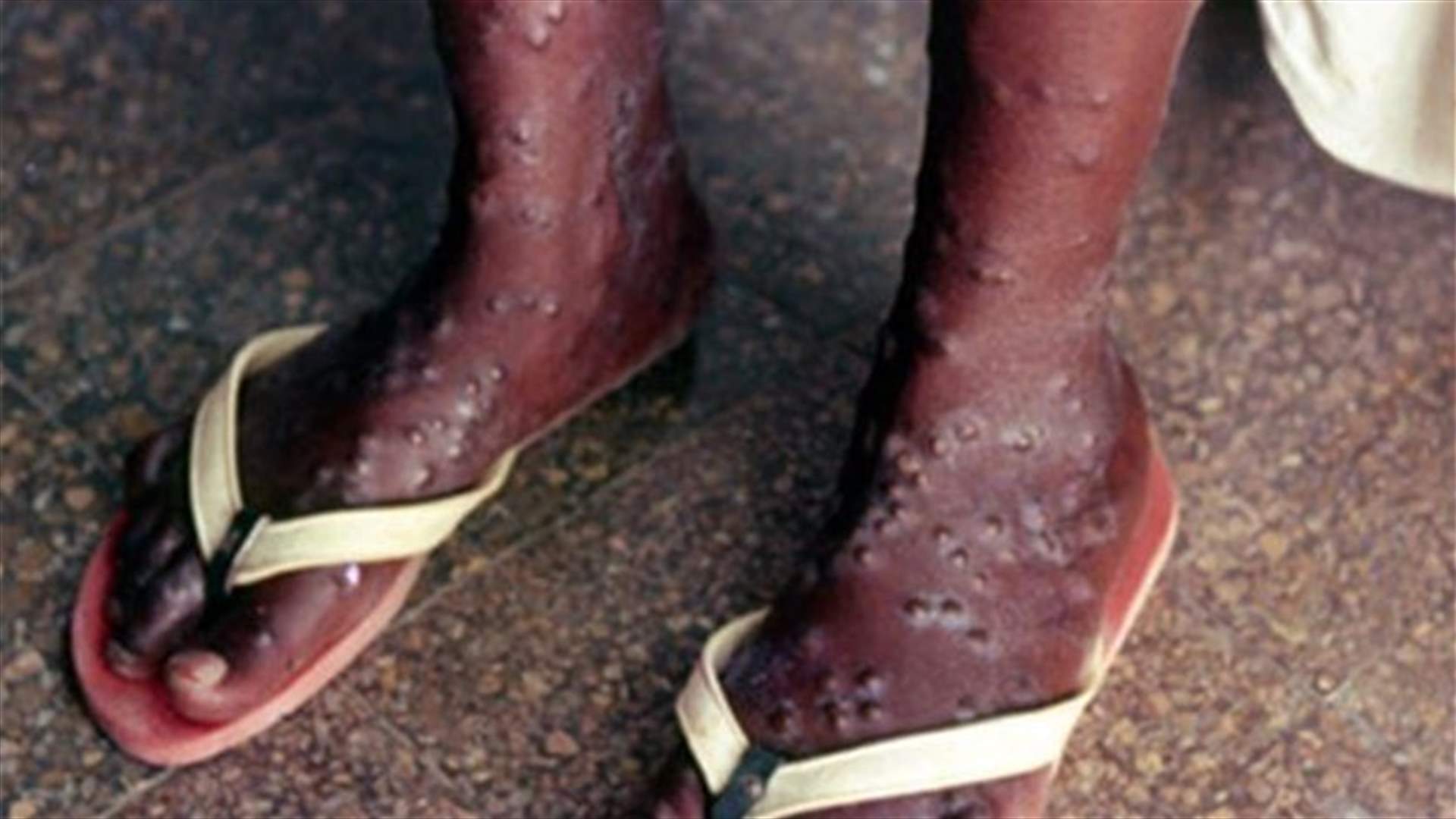 عشرة اشخاص تحت المراقبة الكثيفة خشية اصابتهم بايبولا في تكساس