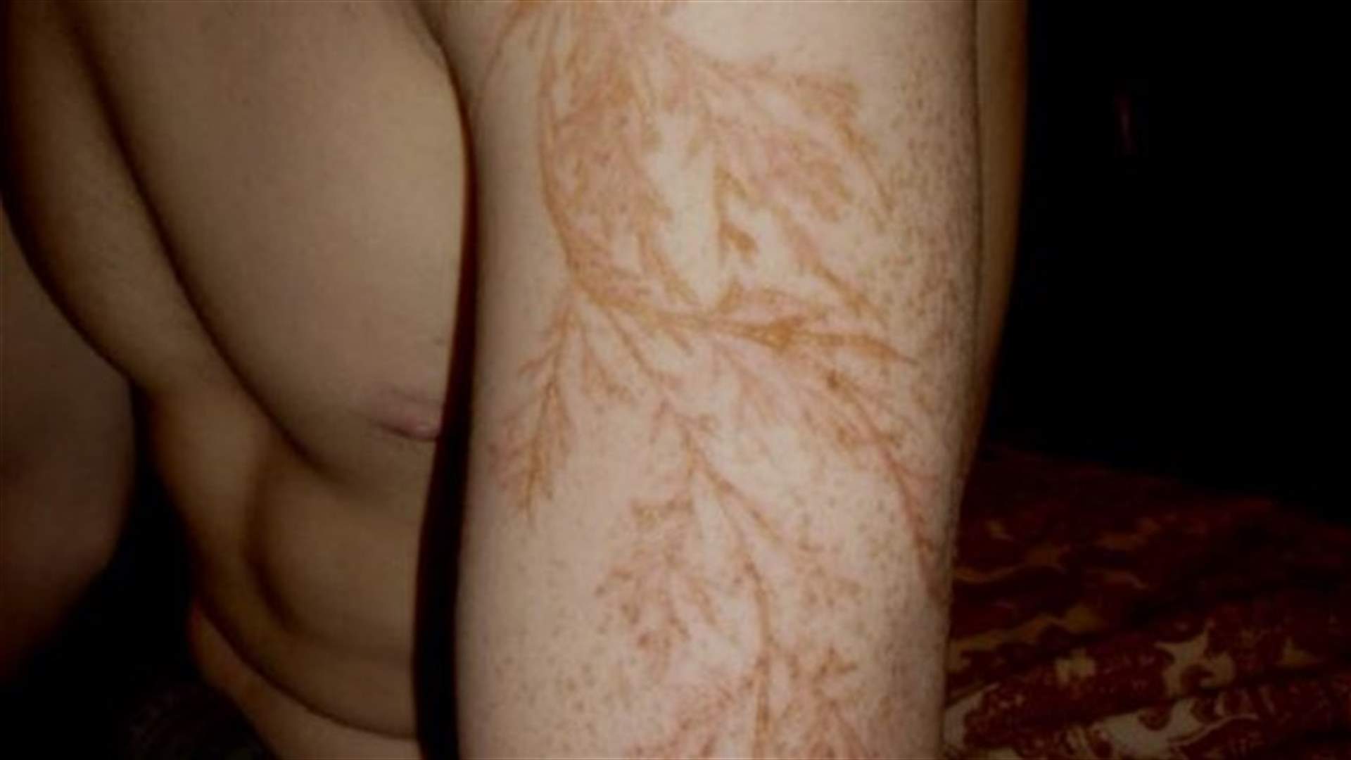 [PHOTOS] Lightning Strike Scars Look Exactly Like Lightning Bolts!