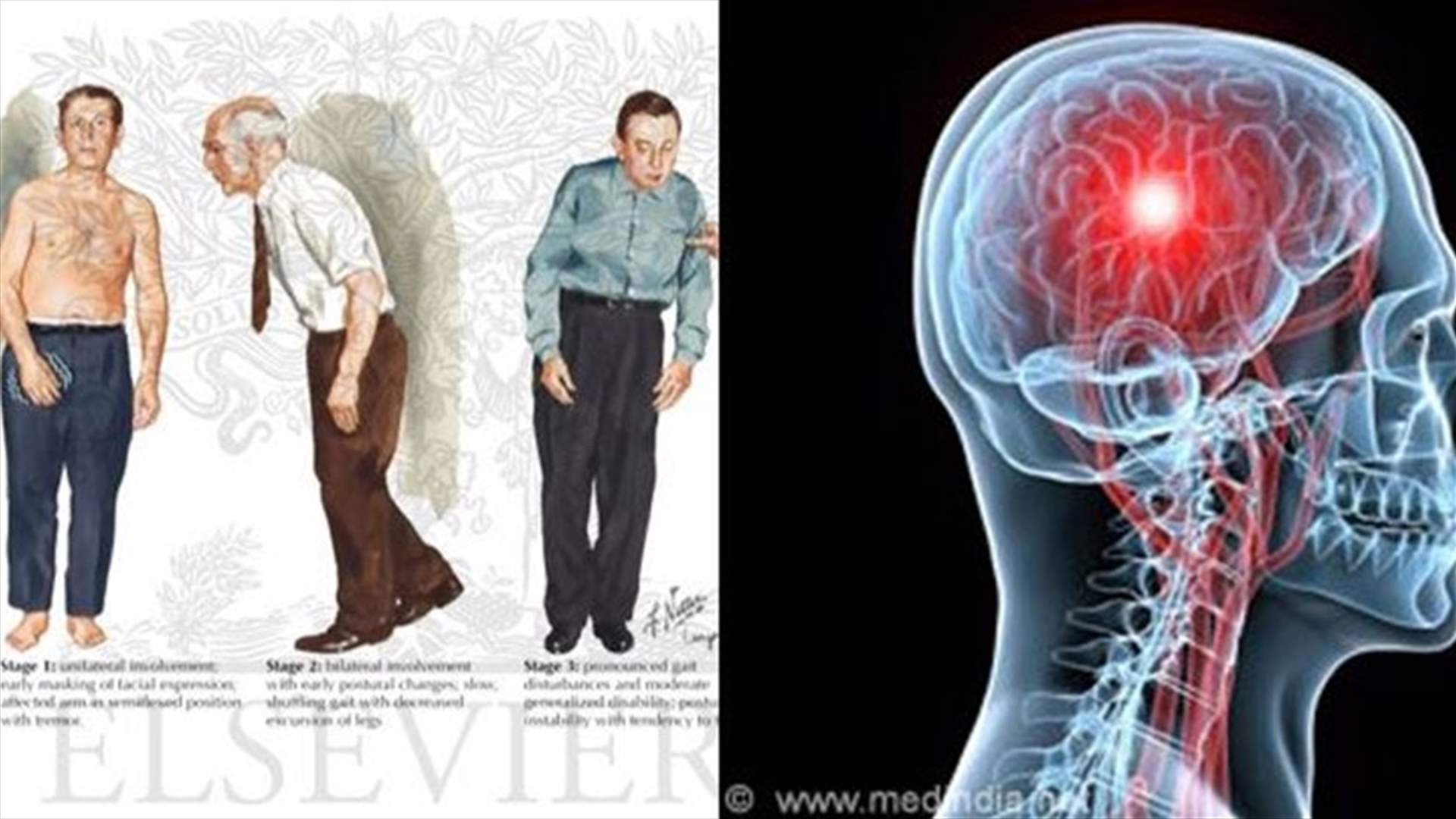 مرض الباركنسون: اسبابه وأعراضه ومراحل تطوره