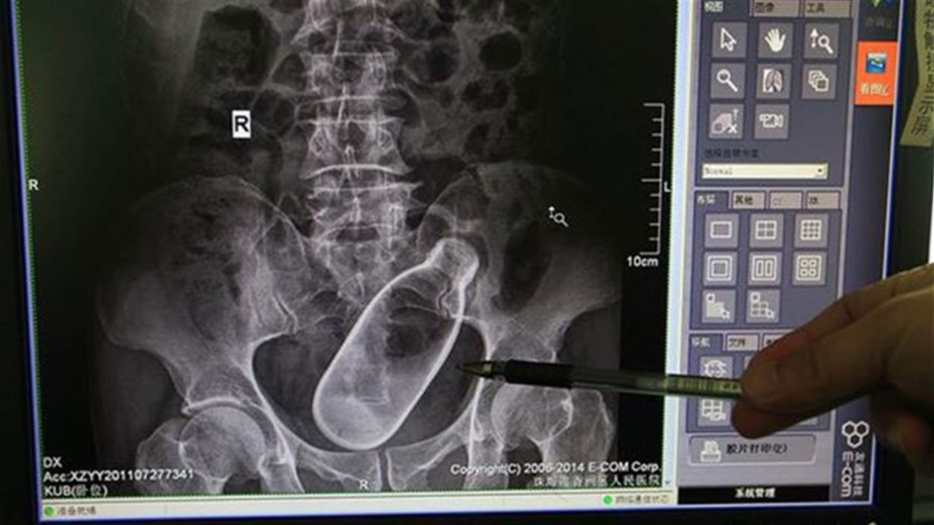 Shocking X-Ray Images Show Man With Bottle Stuck In His Anus