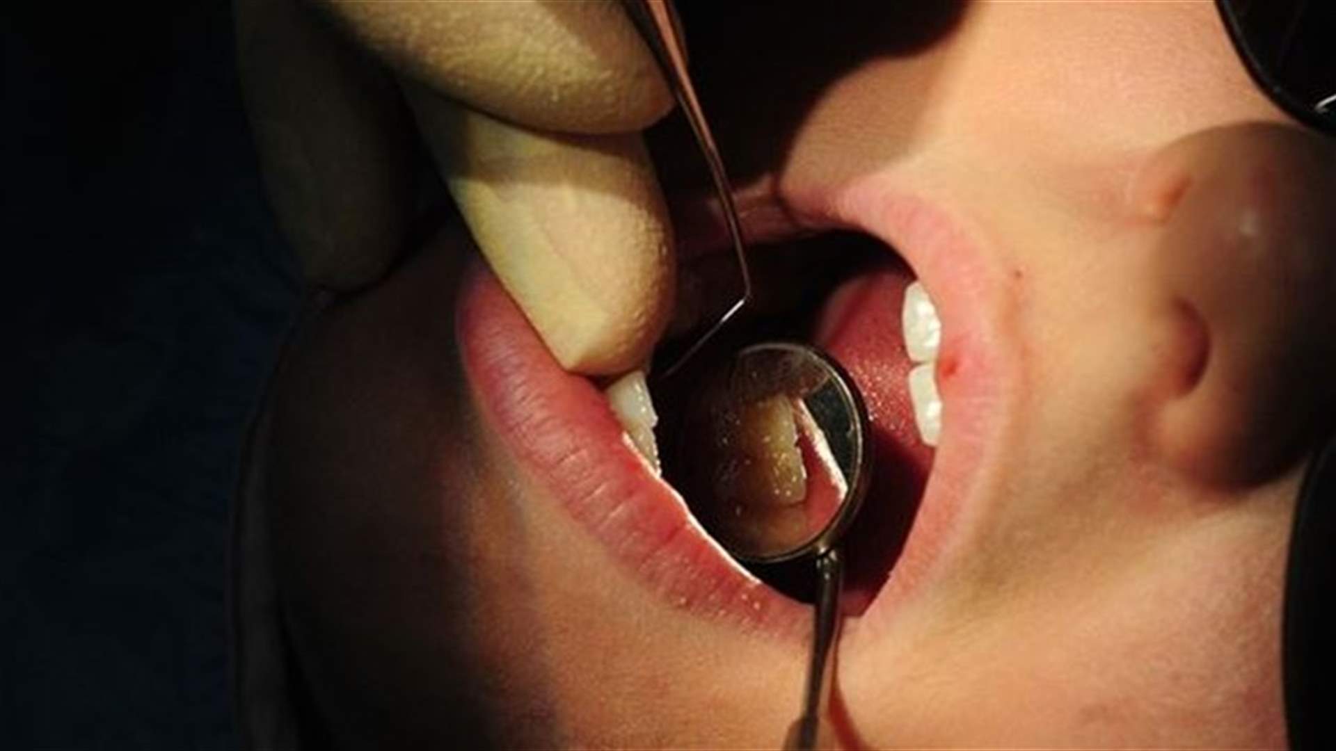 Dental Horror; 22,000 Patients Recalled Over HIV Fears 