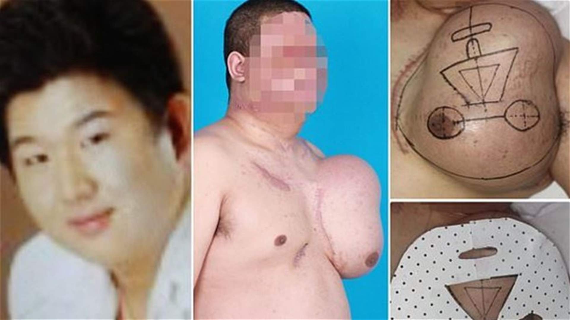 [PHOTOS] Disfigured Man Has New Face Grown On His Chest!