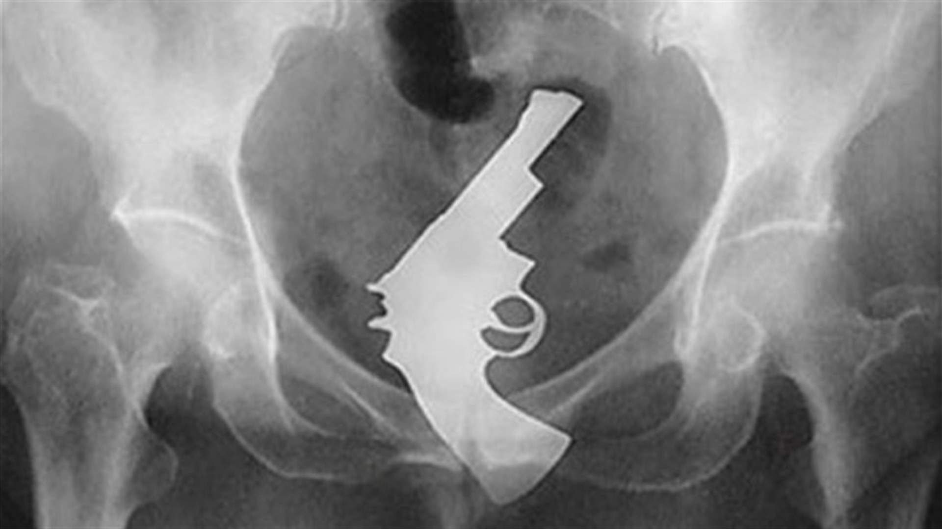 [PHOTOS] The Strangest Objects Ever To Be Extracted From Human Rectums