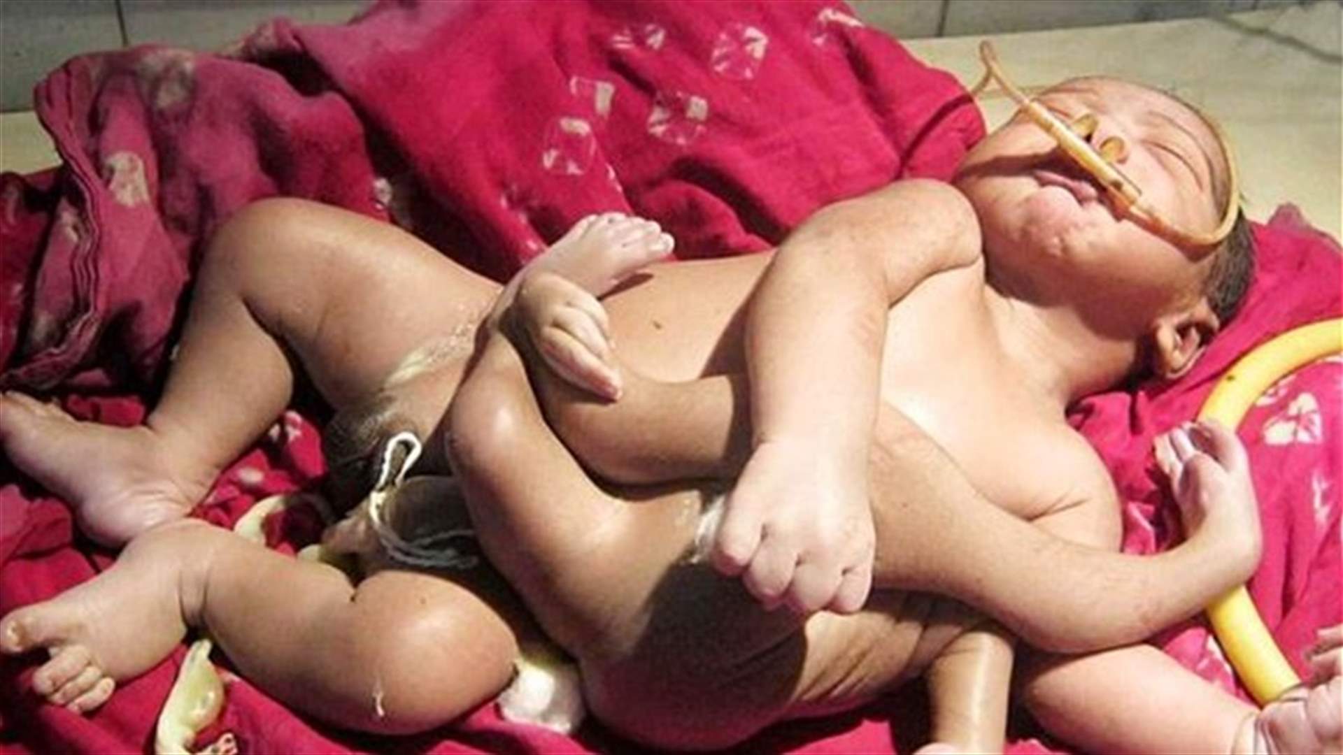 بالصورة طفل بثمانية أطراف يُعبد كالآلهة في الهند
