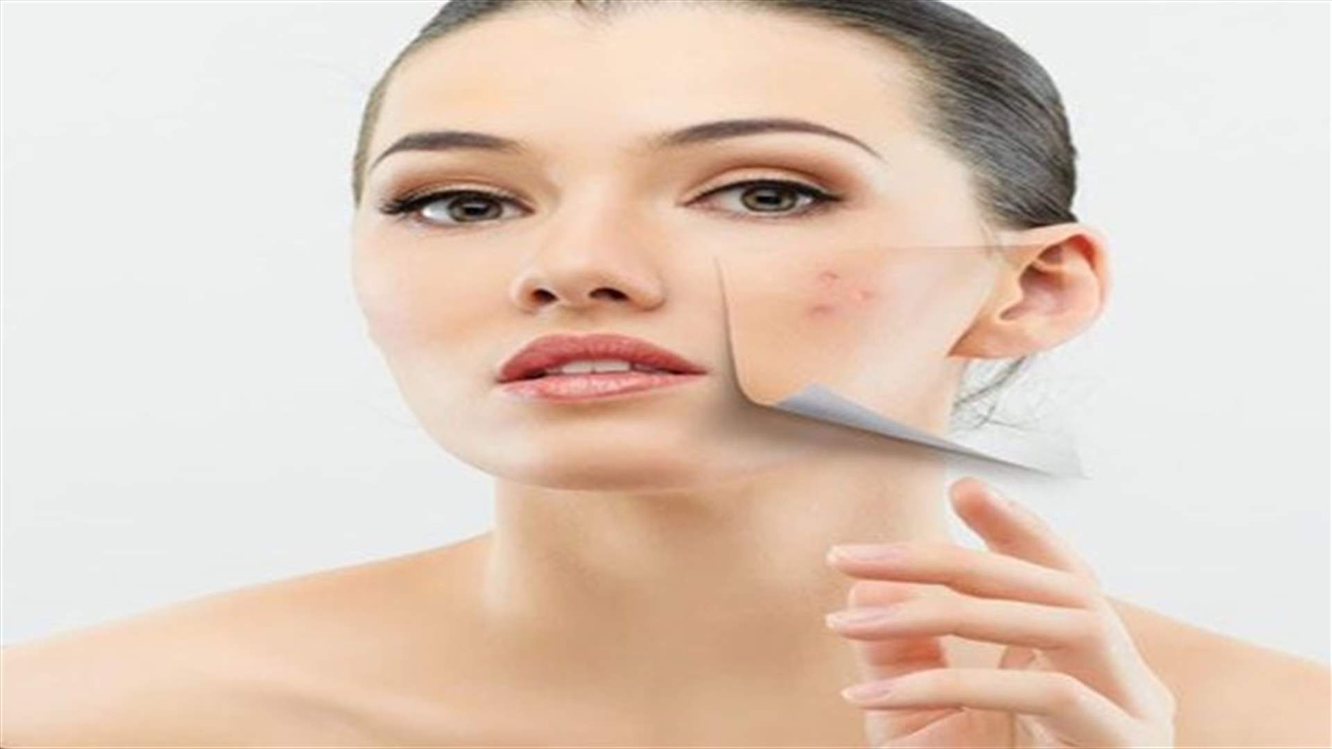 Home Remedy For Acne Scars