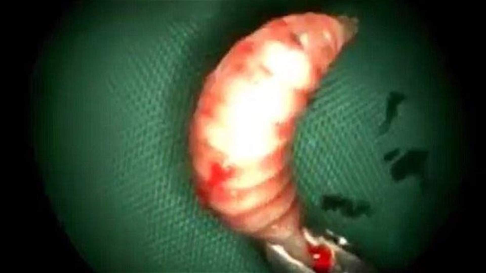 استخراج 50 دودة آكلة للحم من أنف رجل