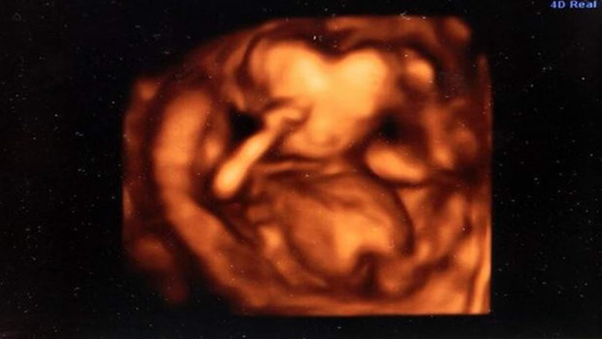 Amazing 3D Ultrasound Scan Shows Baby With Head Shaped Like A Heart