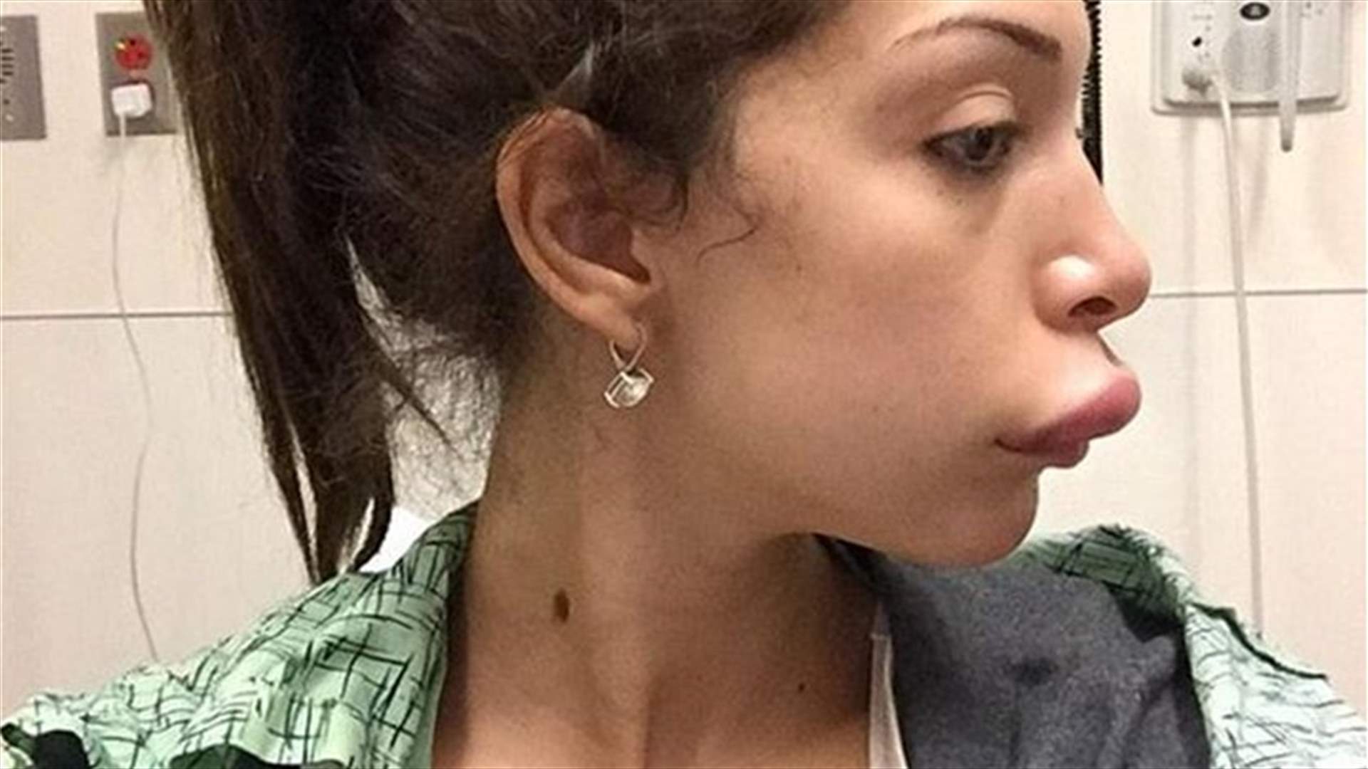 بالصور: حقنت شفتيها بالبوتوكس فهذا ما حصل لها...