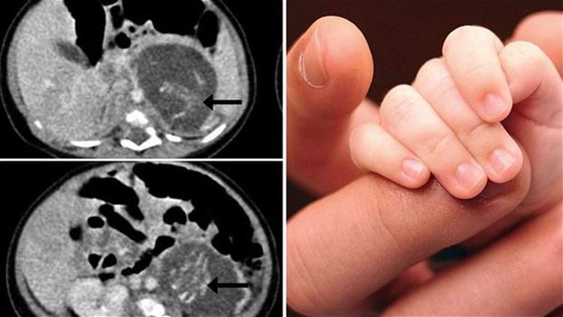 طفلة حديثة الولادة تخضع لعملية إجهاض بعد حملها بتوأم
