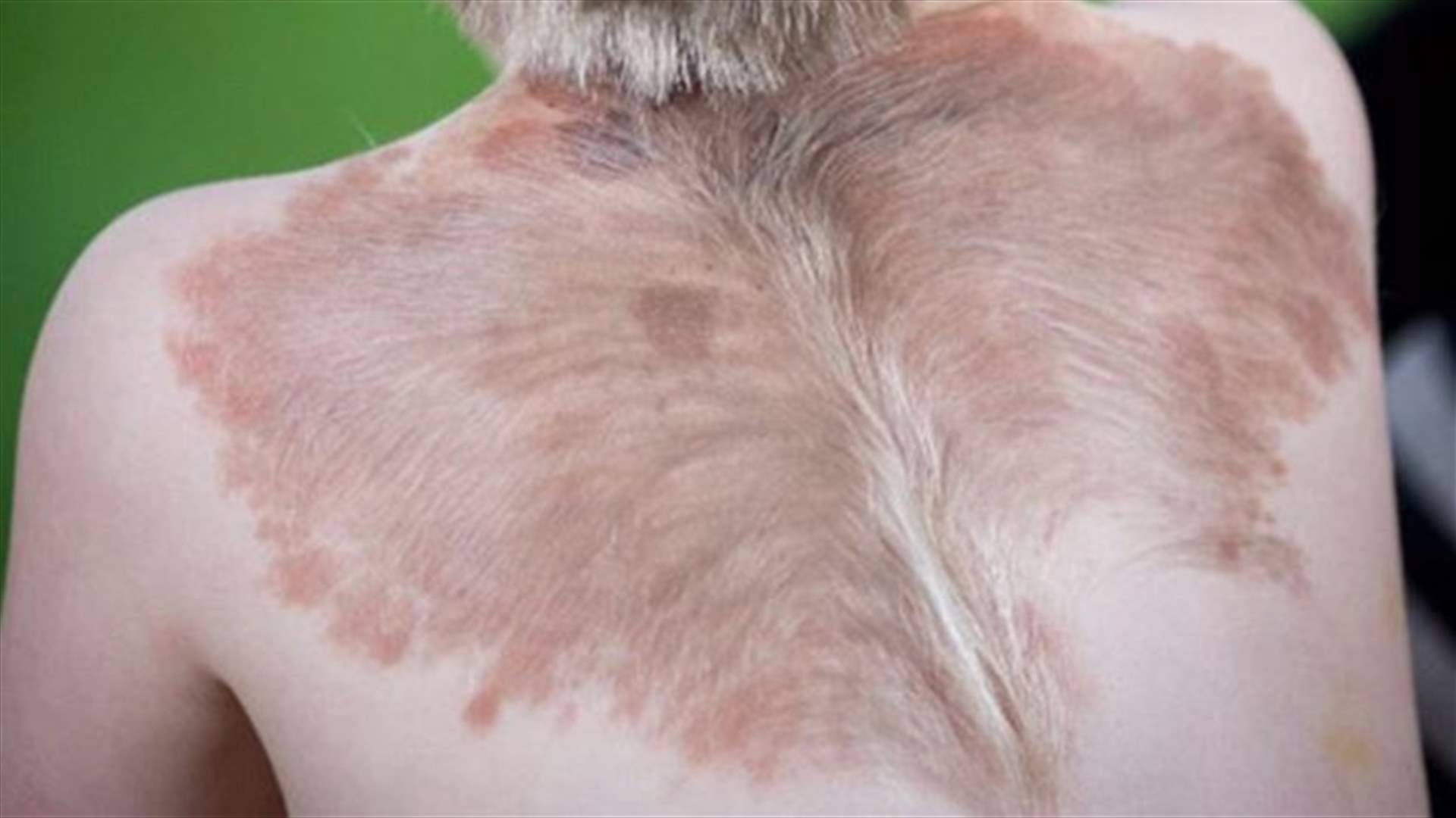 [VIDEO] Toddler Dubbed "Angel Boy" Has Rare Skin Condition That Gives Him "Wings"