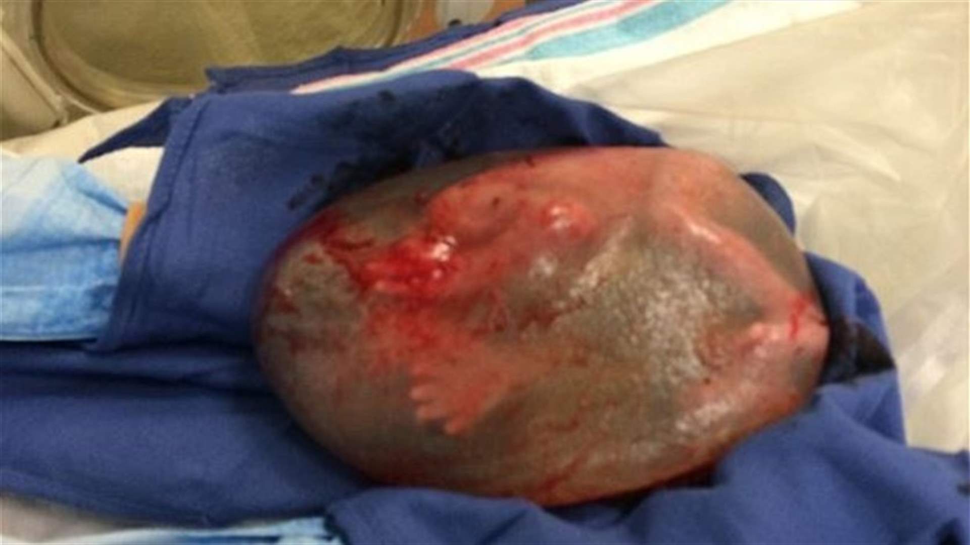 Baby Delivered Still Inside His Amniotic Sac Hailed As ‘Medical Miracle’ By Doctors