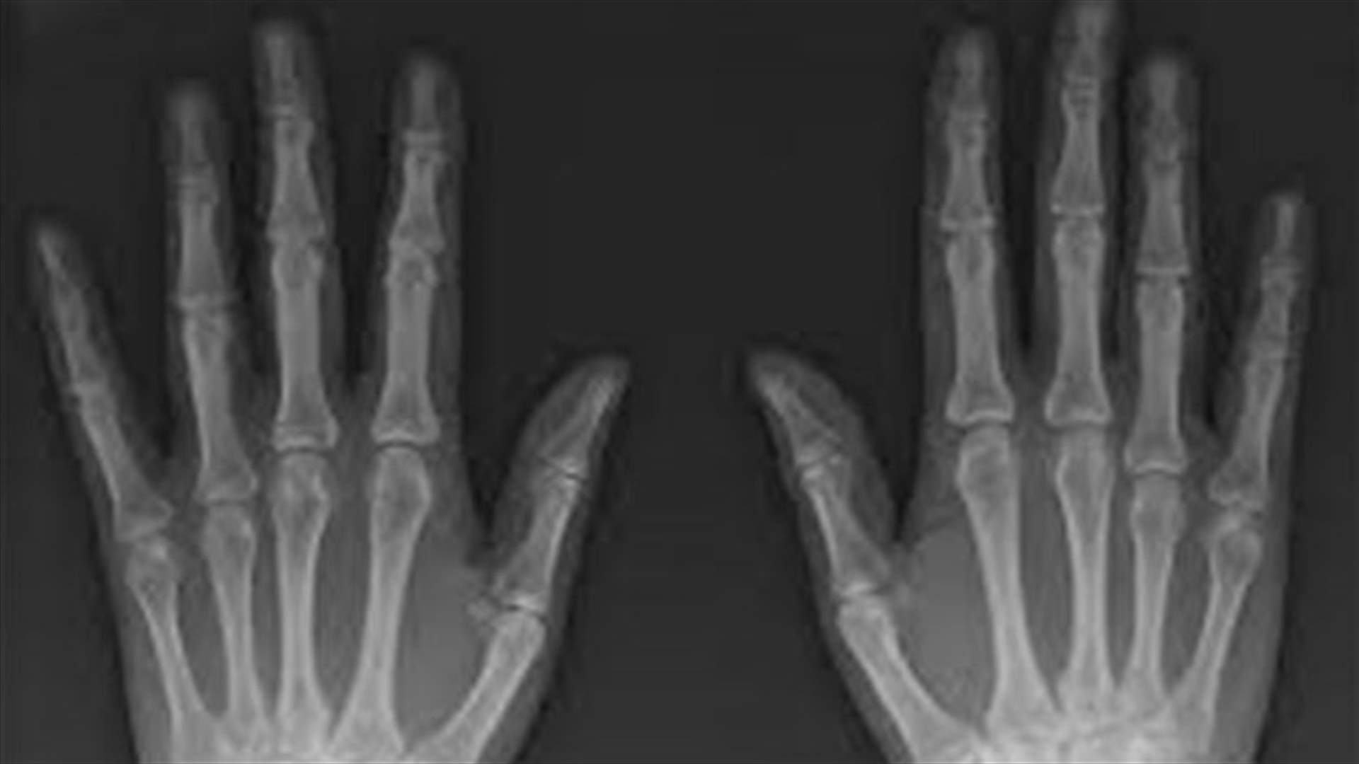 [VIDEO] What Are The Dangers Of Cracking Your Knuckles?