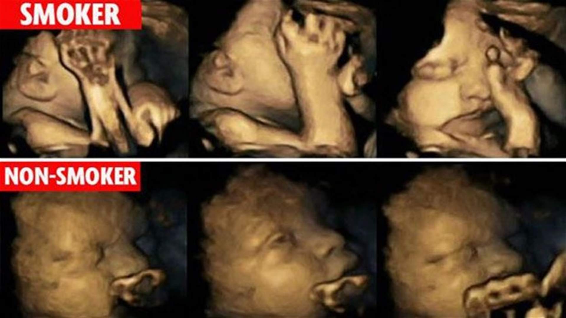 [VIDEO] Remarkable Scans Show Smoking Effects On Unborn Babies