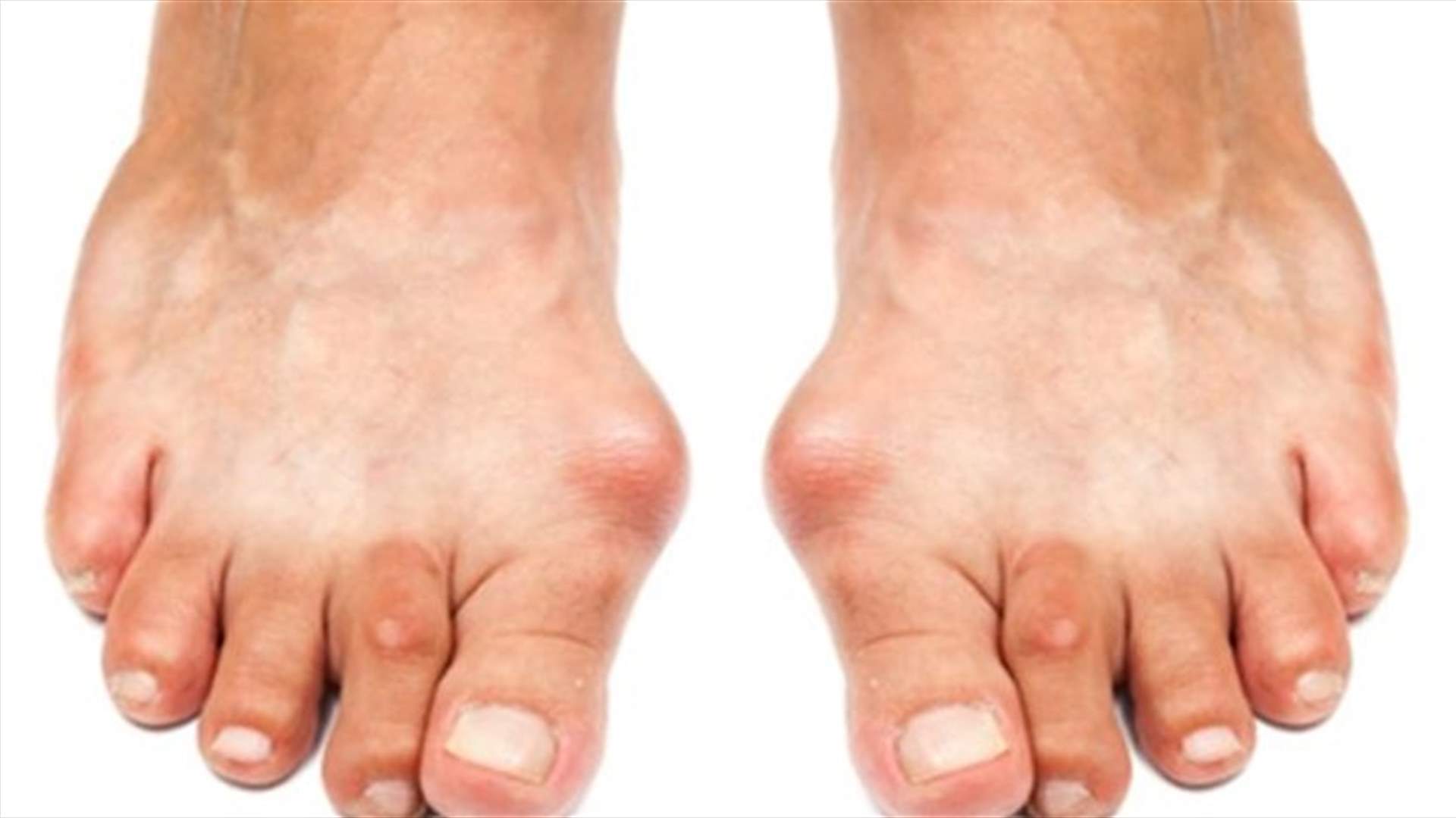 كيف نتخلّص من تورّم مفصل إصبع القدم؟