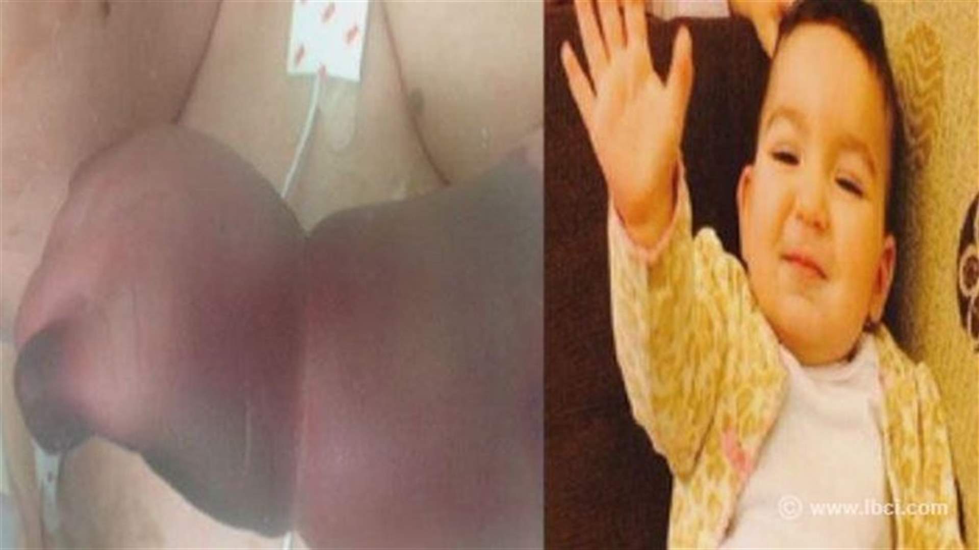 الطفلة "إيلّا" فقدت يدها ورجليها.. وأبو فاعور يتحرك