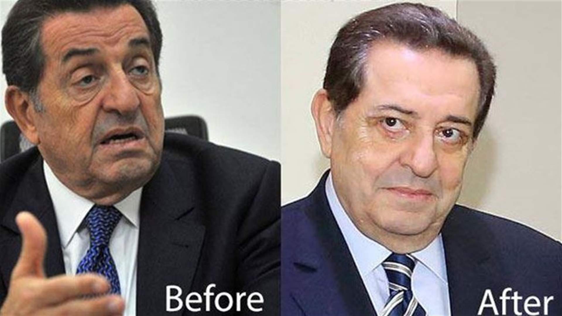 حرب خضع لعملية جراحية في عينيه