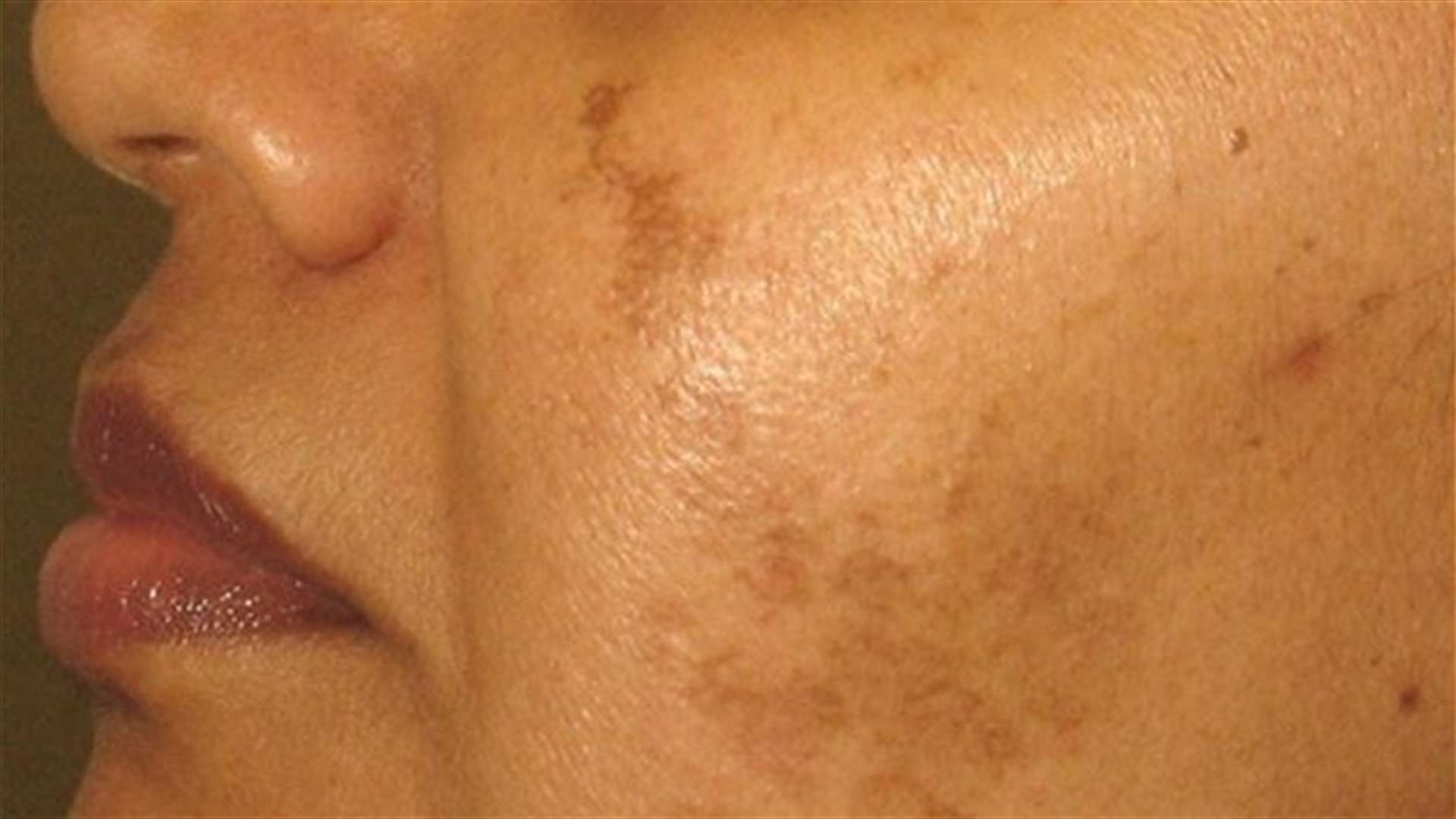 تخلصي من البقع الداكنة بطريقة سهلة وطبيعية