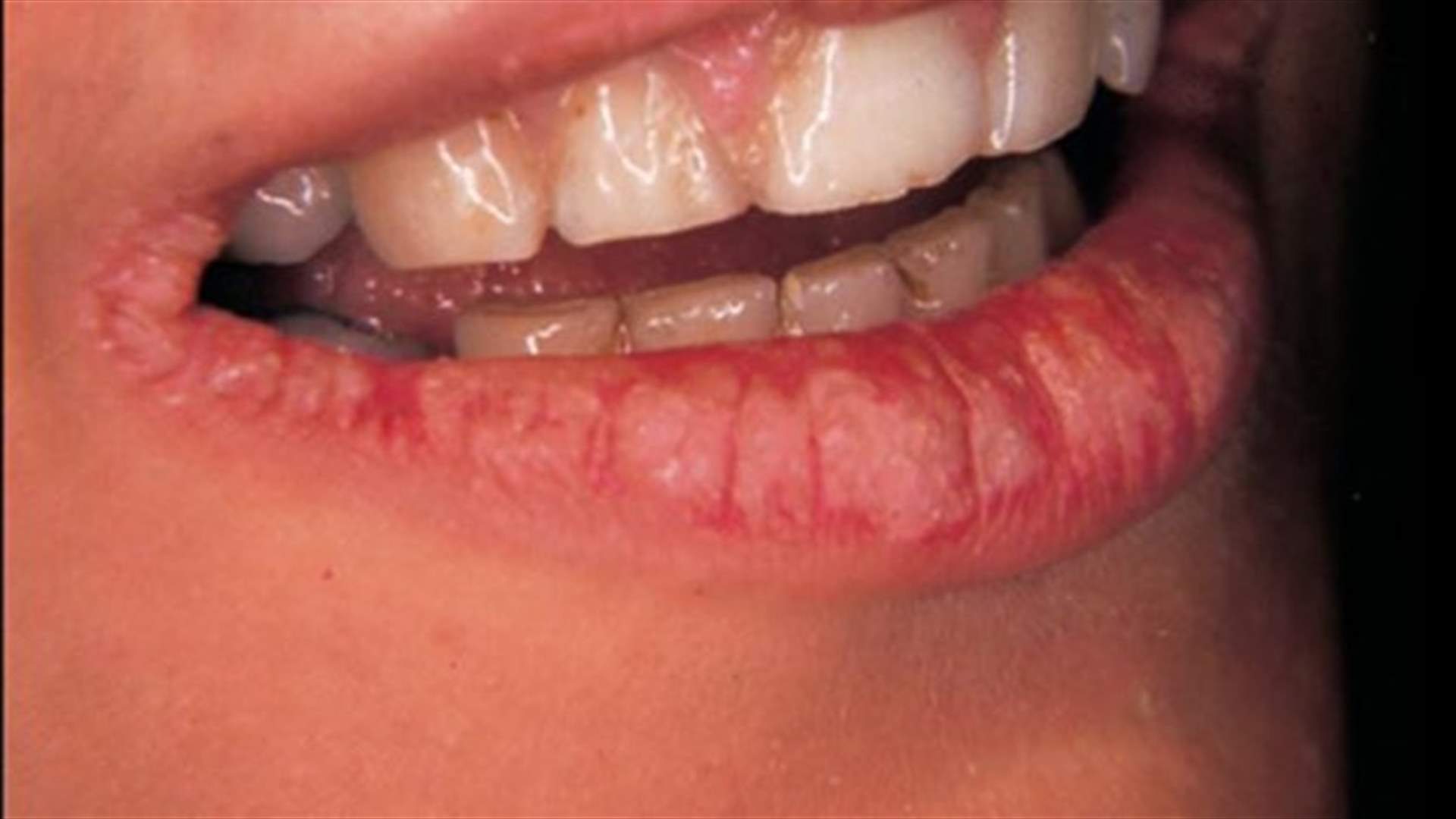 ثلاث وسائل طبيعيّة للتخلّص من الفطريات