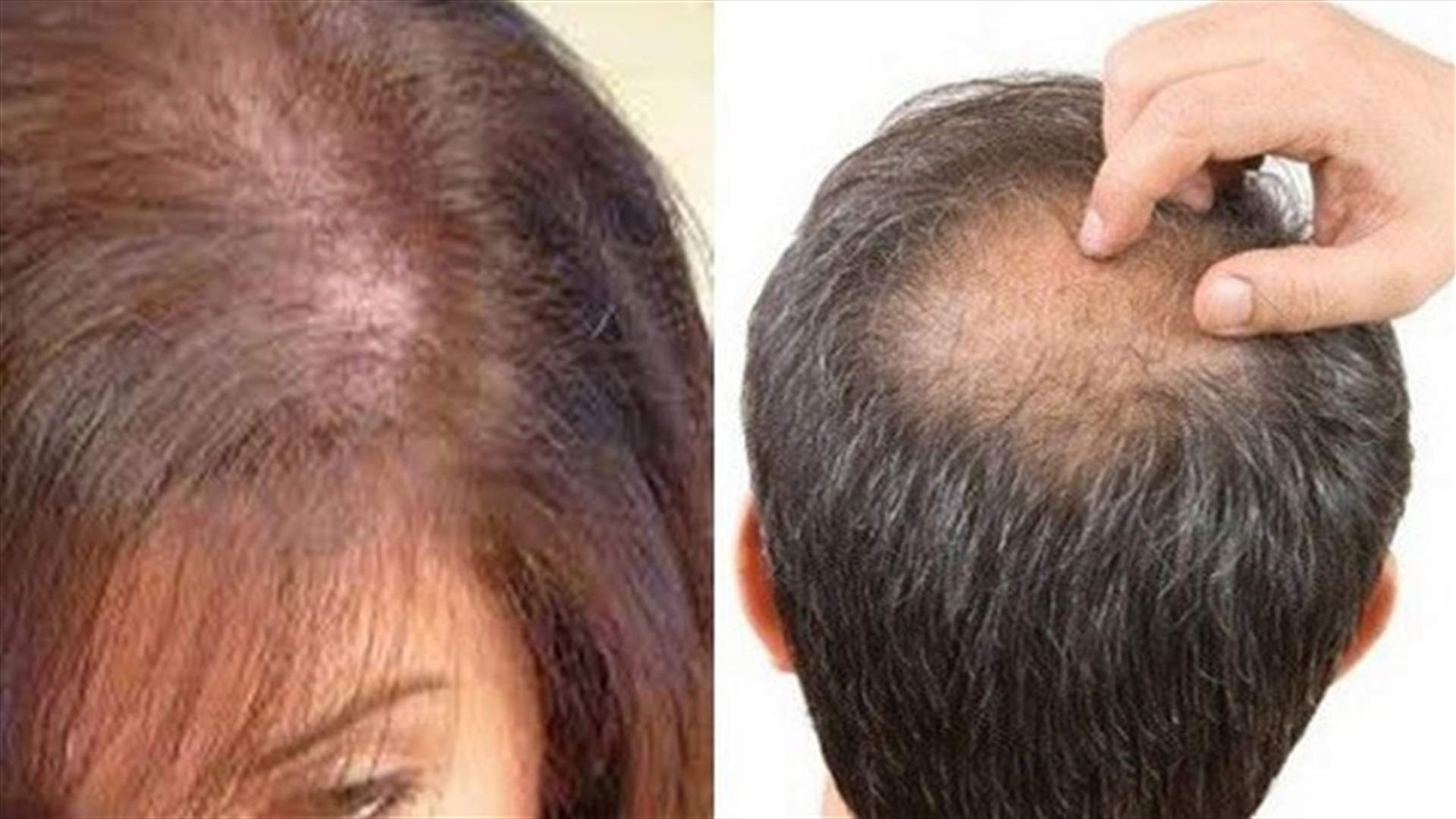 هكذا نكافح تساقط الشعر