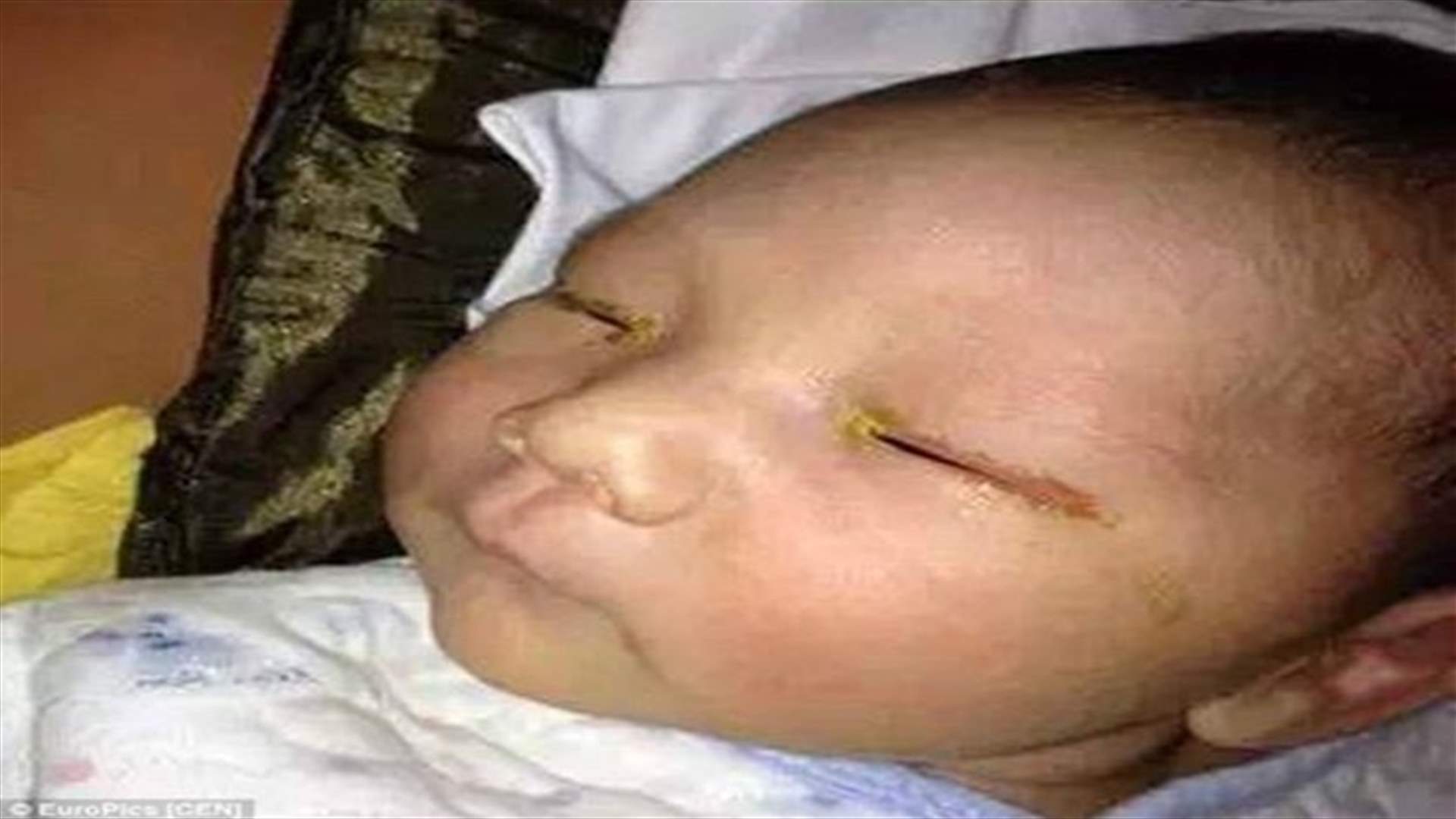 تحذير! فلاش كاميرا يصيب طفلاً بالعمى