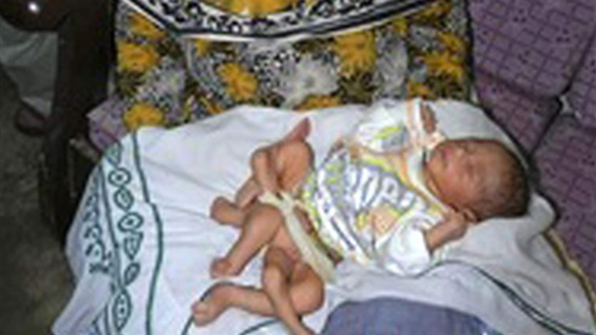 Six-legged baby born, in stable condition