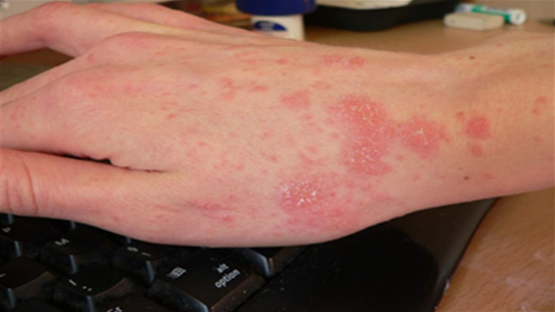 Contagious disease spreads among Syrian refugees in Donniyeh