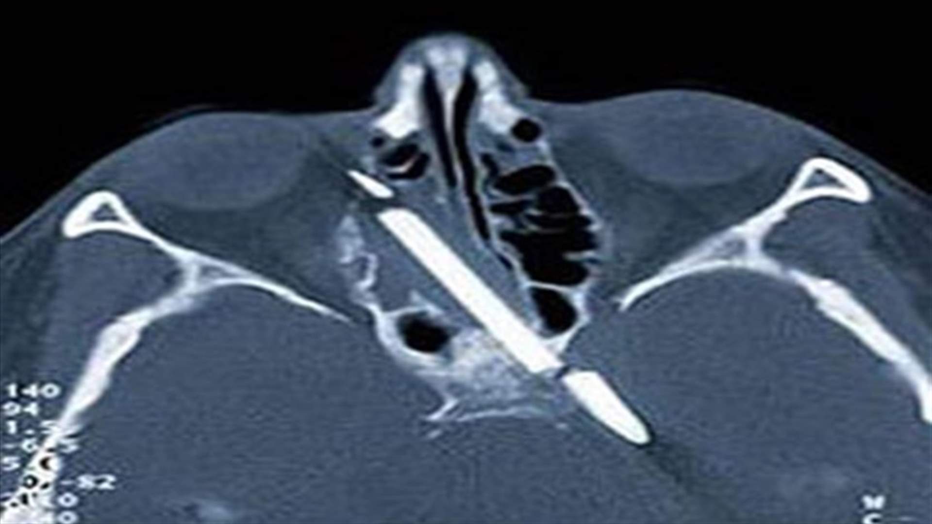 German clinic: Man had pencil in head for 15 years
