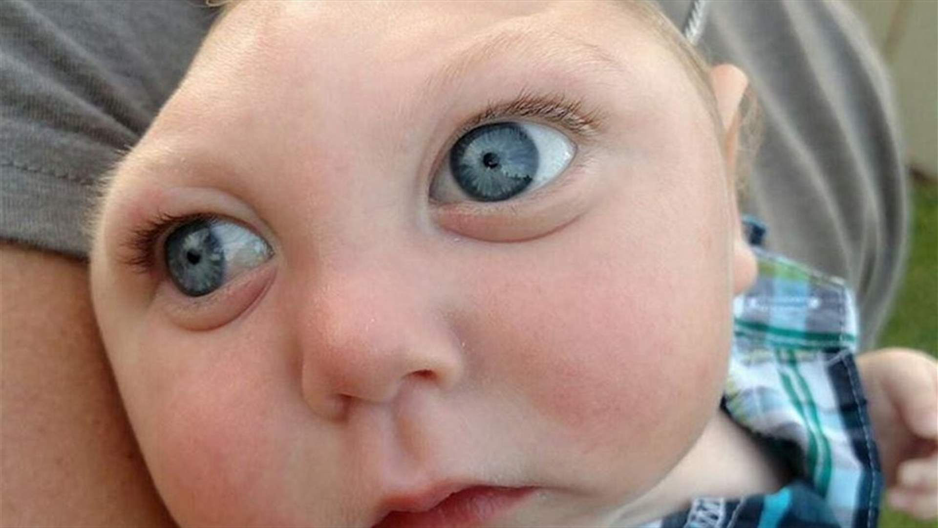 طفل ولد بنصف دماغ يتحدّى الأطباء ويحتفل بعامه الاول 