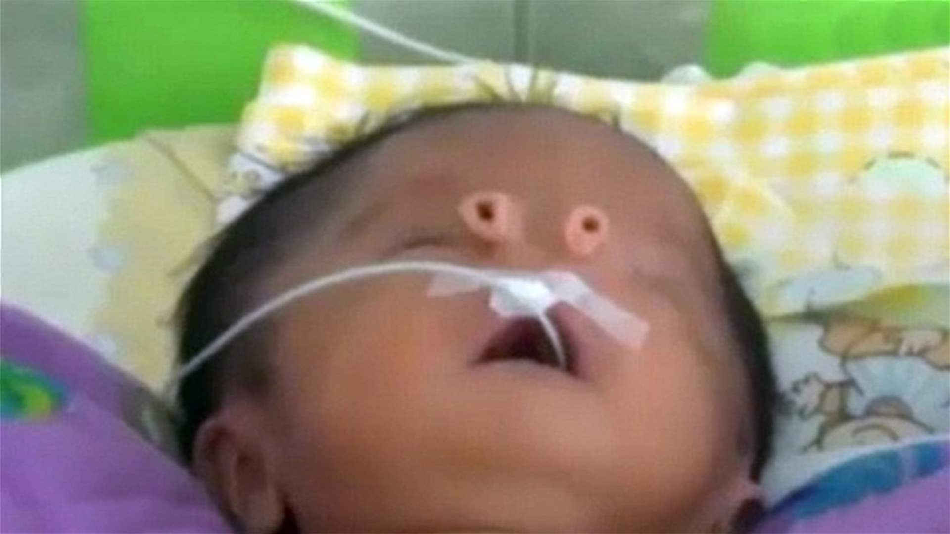 بالفيديو....طفل بأنبوبين بدلا من الأنف 