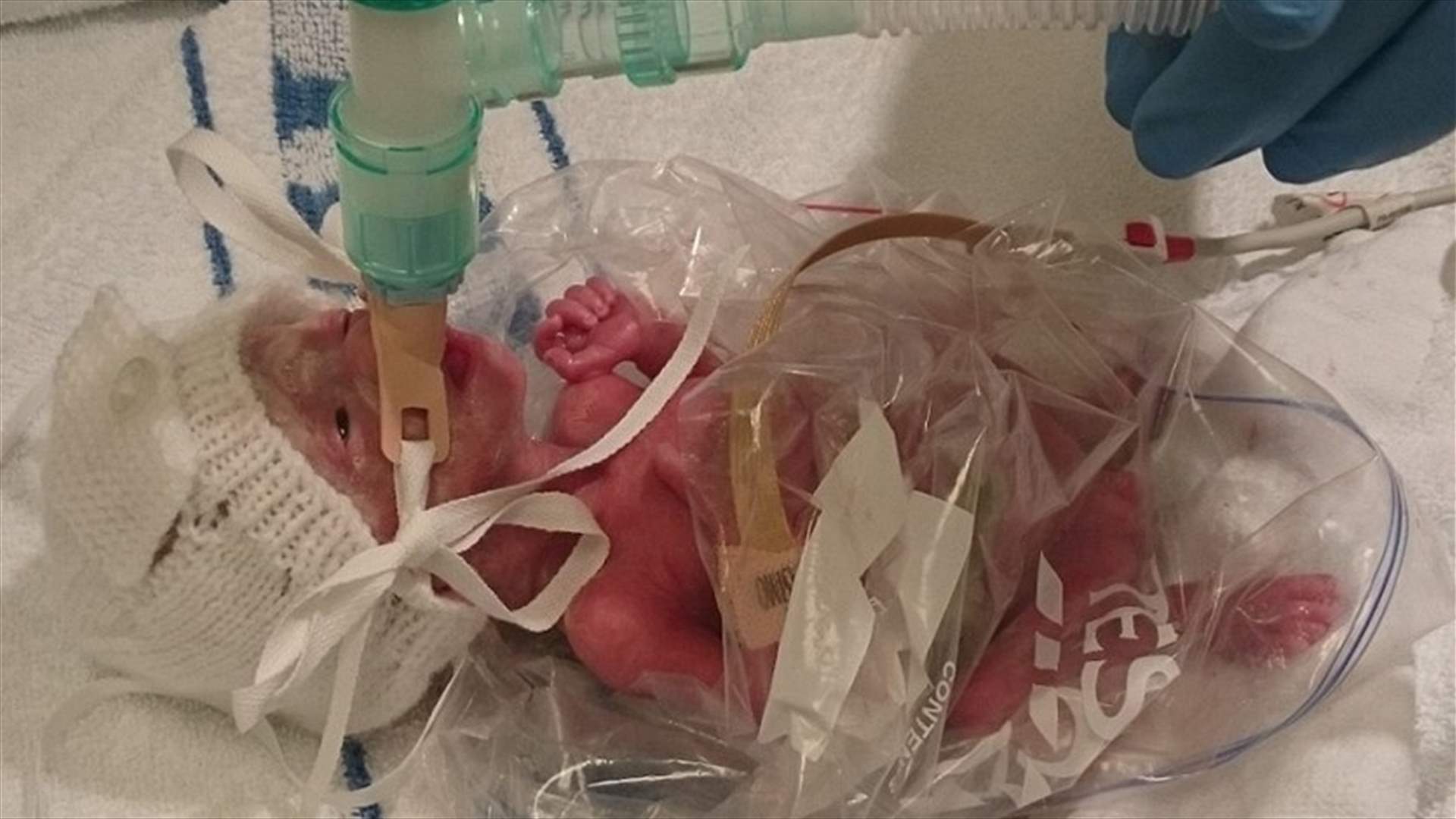 لماذا وُضعت الطفلة داخل كيسٍ بلاستيكي بعد ولادتها؟