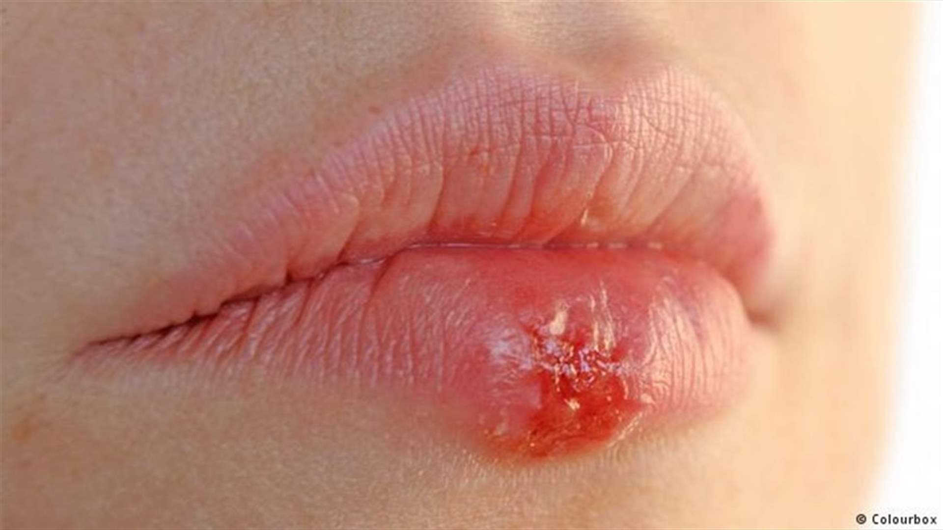 الفيروس الذي يُعاني منه ثلثا سكان العالم