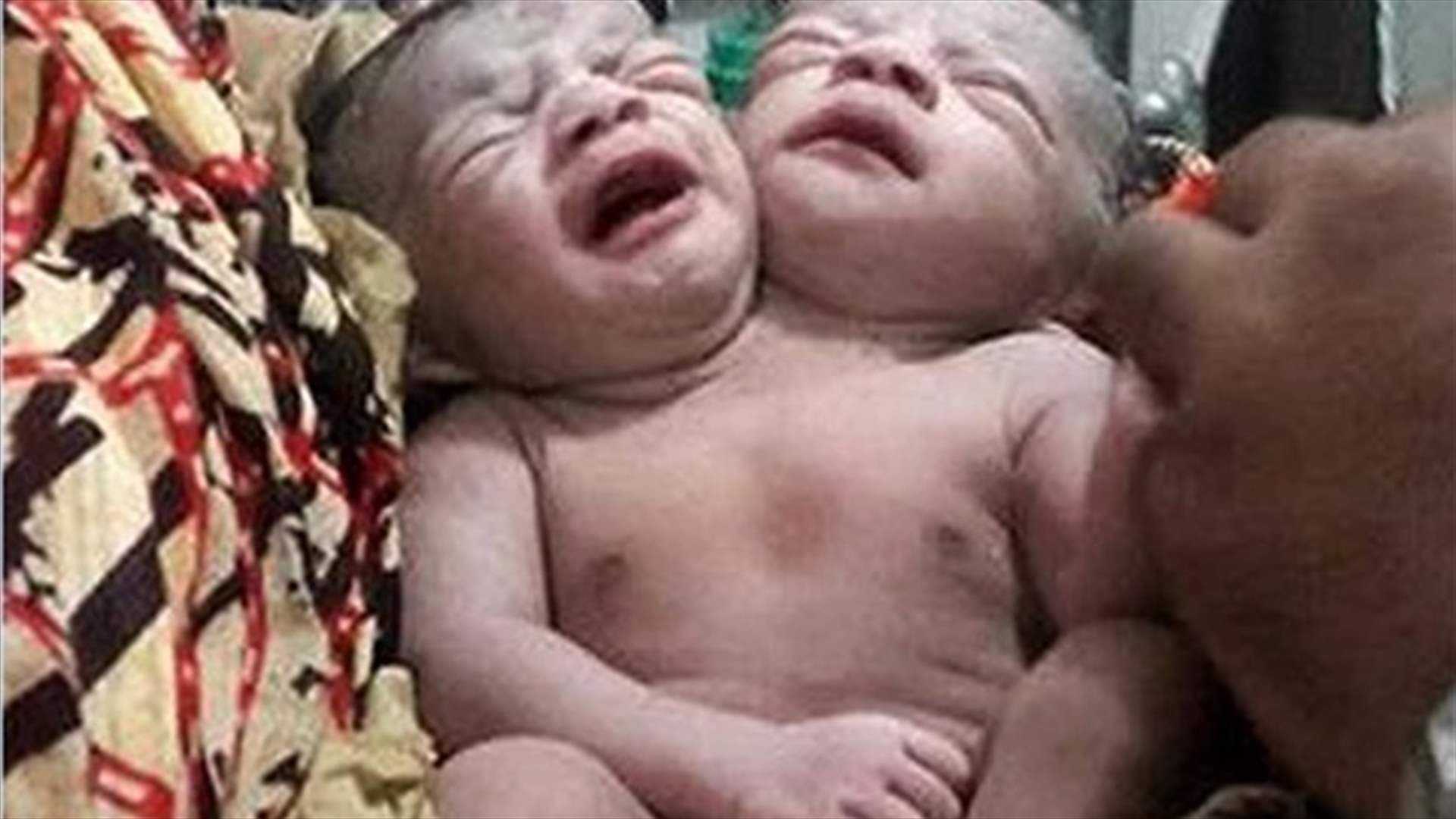 ولادة طفلة معجزة في بنغلاديش بجسمٍ واحد ورأسين
