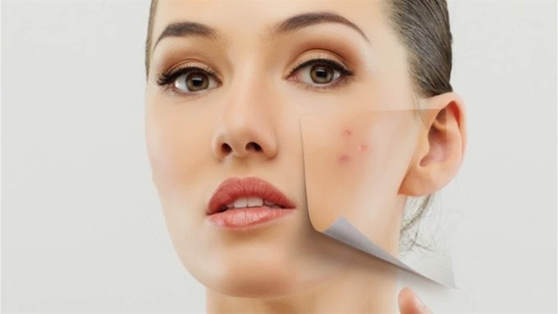 3 حلول للتخلّص من آثار حبّ الشباب