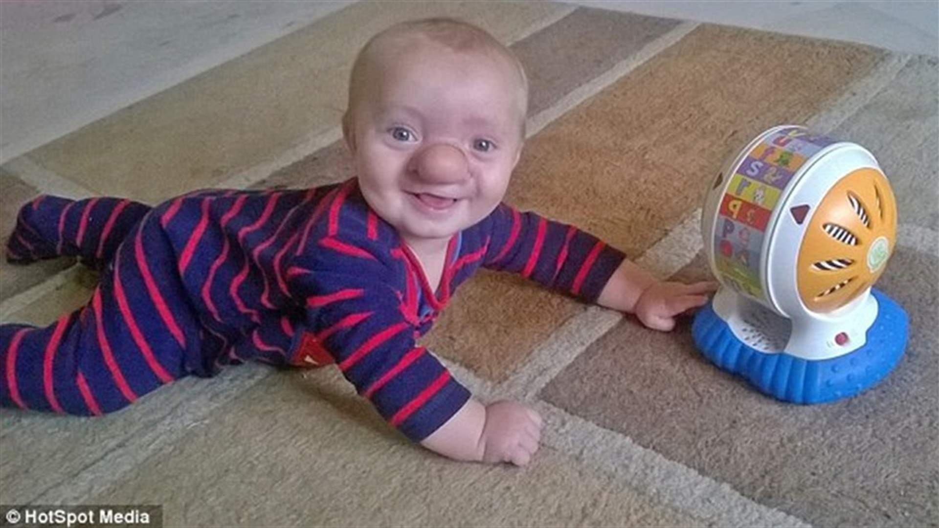 بالصور: طفل ولد بحالةٍ نادرة... ووالدته تطلق عليه اسم "بينوكيو" 