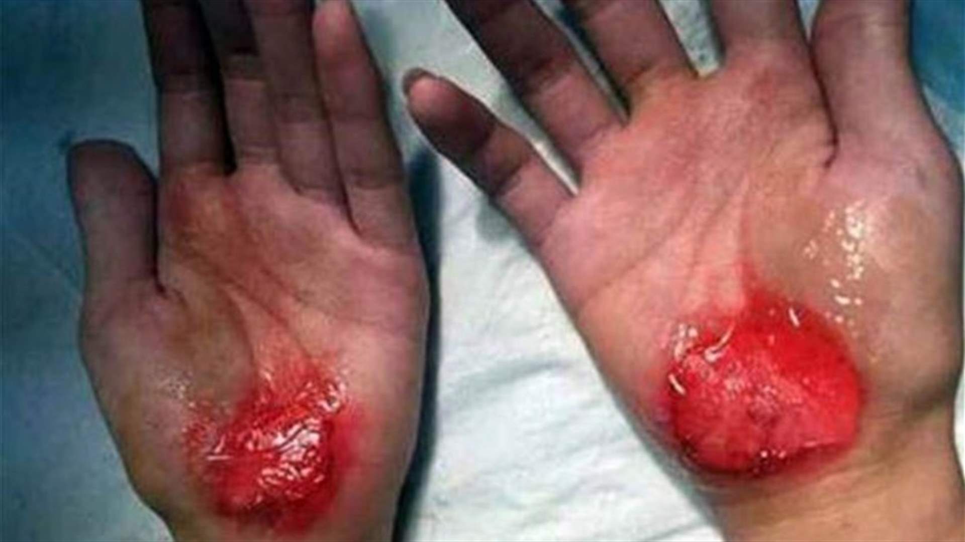 China School Children Forced to Walk on Their Hands in Bloody Punishment 