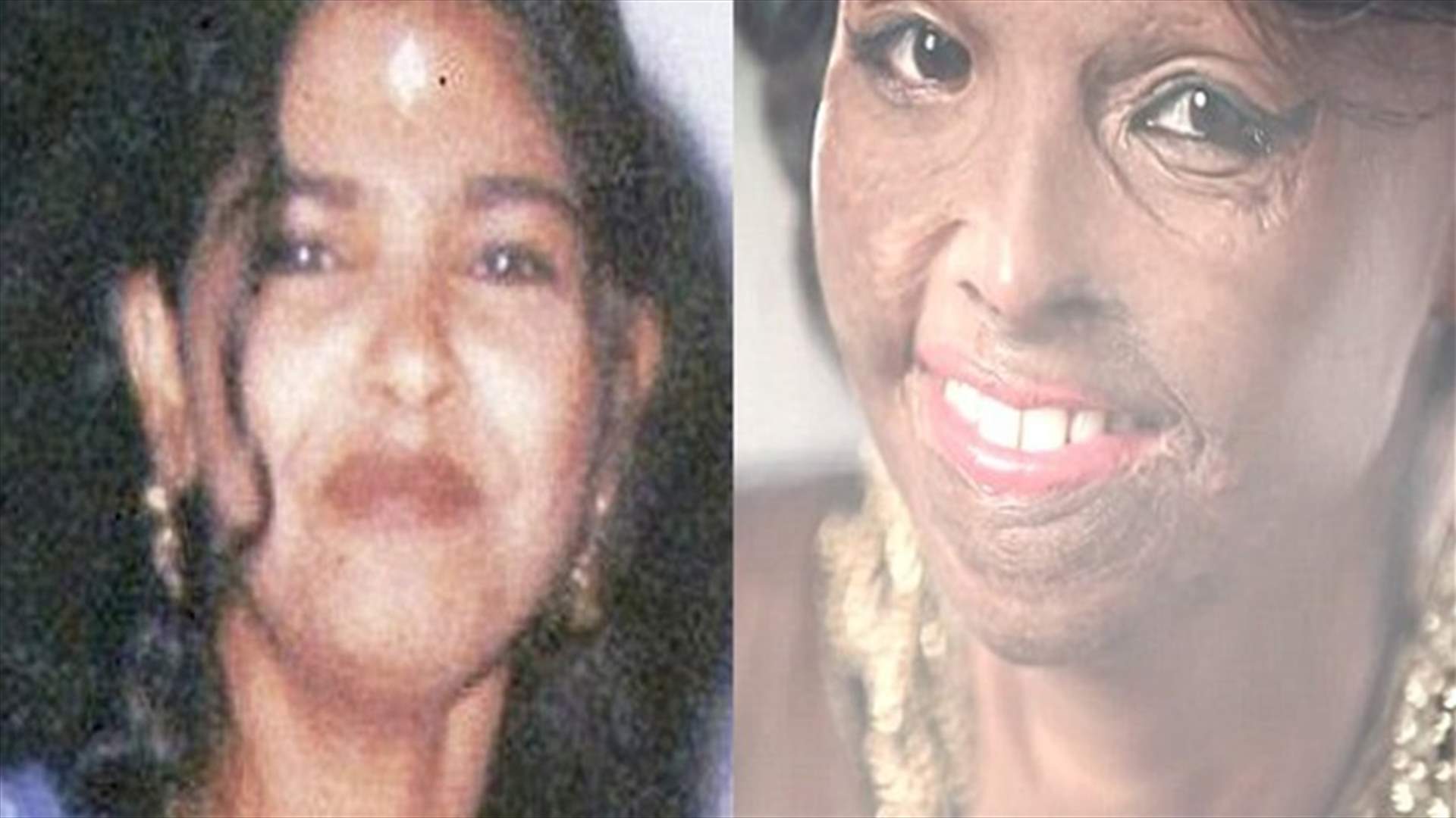 امرأة مشوّهة بالأسيد تُصبح الوجه الإعلانيّ لماركة أزياء مهمّة
